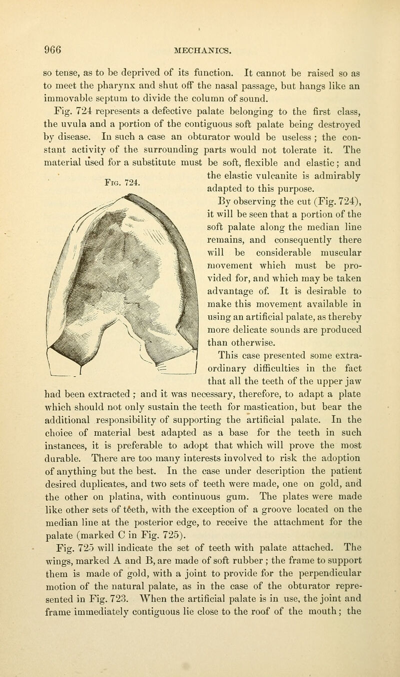 Fig. 724. SO tense, as to be deprived of its function. It cannot be raised so as to meet the pharynx and shut off the nasal passage, but hangs like an immovable septum to divide the column of sound. Fig. 724 represents a defective palate belonging to the first class, the uvula and a portion of the contiguous soft palate being destroyed by disease. In such a case an obturator would be useless ; the con- stant activity of the surrounding parts would not tolerate it. The material used for a substitute must be soft, flexible and elastic; and the elastic vulcanite is admirably adapted to this purpose. By observing the cut (Fig. 724), it will be seen that a portion of the soft palate along the median line remains, and consequently there will be considerable muscular movement which must be pro- vided for, and which may be taken advantage of. It is desirable to make this movement available in using an artificial palate, as thereby more delicate sounds are produced than otherwise. This case presented some extra- ordinary difficulties in the fact that all the teeth of the upper jaw had been extracted ,• and it was necessary, therefore, to adapt a plate which should not only sustain the teeth for mastication, but bear the additional responsibility of supporting the artificial palate. In the choice of material best adapted as a base for the teeth in such instances, it is preferable to adopt that which will prove the most durable. There are too many interests involved to risk the adoption of anything but the best. In the case under description the patient desired duplicates, and two sets of teeth were made, one on gold, and the other on platina, with continuous gum. The plates were made like other sets of tfeeth, with the exception of a groove located on the median line at the posterior edge, to receive the attachment for the palate (marked C in Fig. 725). Fig. 725 will indicate the set of teeth with palate attached. The wings, marked A and B, are made of soft rubber ; the frame to support them is made of gold, with a joint to provide for the perpendicular motion of the natural palate, as in the case of the obturator repre- sented in Fig. 723. When the artificial palate is in use, the joint and frame immediately contiguous lie close to the roof of the mouth; the