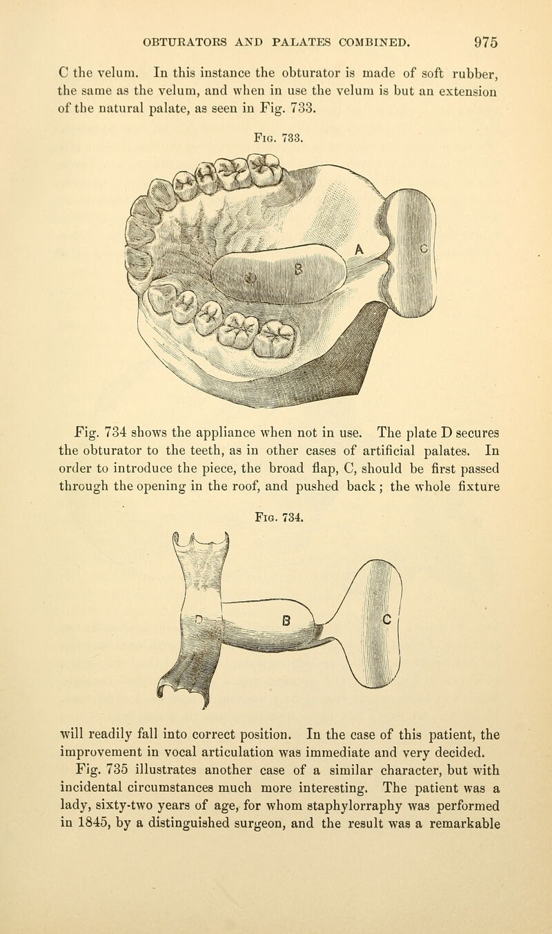 C the velum. In this instance the obturator is made of soft rubber, the same as the velum, and when in use the velum is but an extension of the natural palate, as seen in Fig. 733. Fig. 733. Fig. 734 shows the appliance when not in use. The plate D secures the obturator to the teeth, as in other cases of artificial palates. In order to introduce the piece, the broad flap, C, should be first passed through the opening in the roof, and pushed back ; the whole fixture Fig. 734. •will readily fall into correct position. In the case of this patient, the improvement in vocal articulation was immediate and very decided. Fig. 735 illustrates another case of a similar character, but with incidental circumstances much more interesting. The patient was a lady, sixty-two years of age, for whom staphylorraphy was performed in 1845, by a distinguished surgeon, and the result was a remarkable