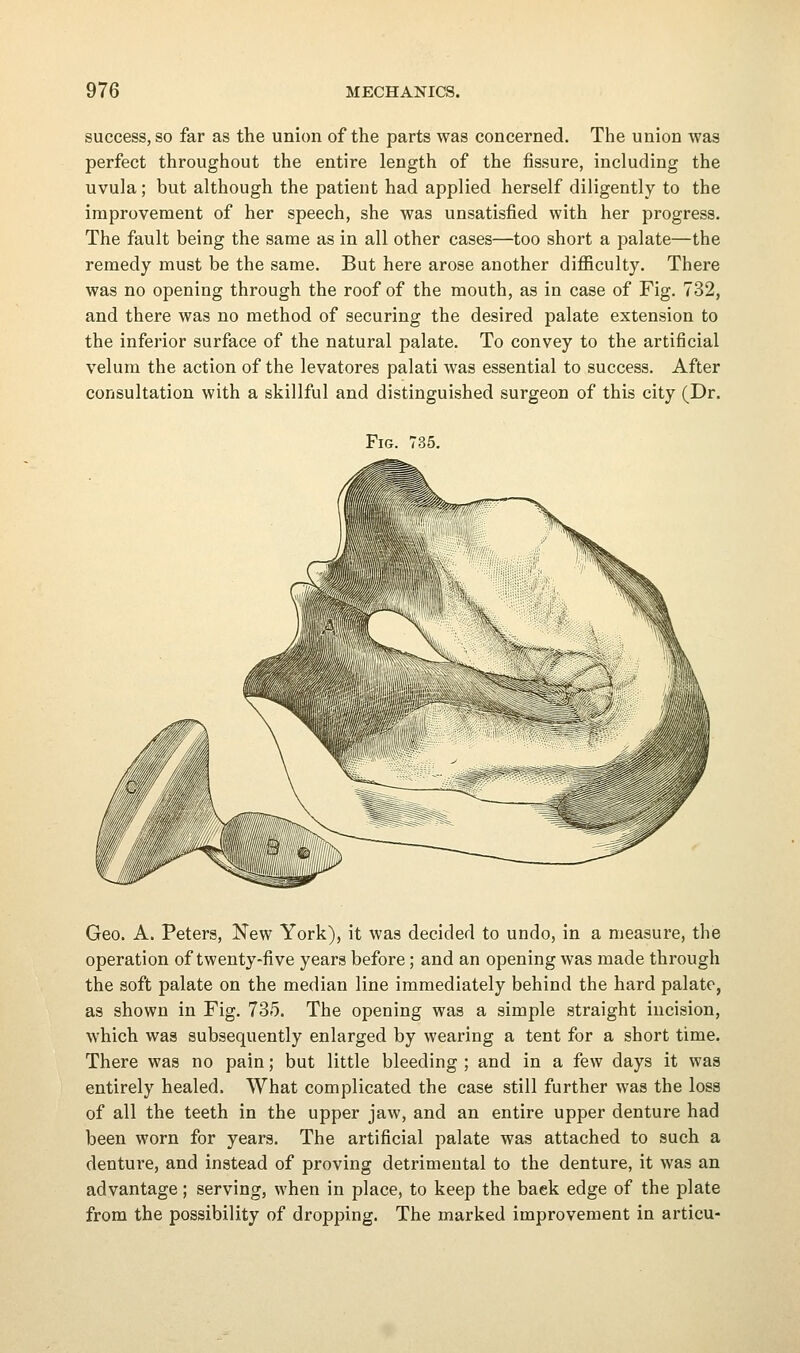 success, so far as the union of the parts was concerned. The union was perfect throughout the entire length of the fissure, including the uvula; but although the patient had applied herself diligently to the improvement of her speech, she was unsatisfied with her progress. The fault being the same as in all other cases—too short a palate—the remedy must be the same. But here arose another difficulty. There was no opening through the roof of the mouth, as in case of Fig. 732, and there was no method of securing the desired palate extension to the inferior surface of the natural palate. To convey to the artificial velum the action of the levatores palati was essential to success. After consultation with a skillful and distinguished surgeon of this city (Dr. Fig. 735. Geo. A. Peters, New York), it was decided to undo, in a measure, the operation of twenty-five years before; and an opening was made through the soft palate on the median line immediately behind the hard palate, as shown in Fig. 735. The opening was a simple straight incision, which was subsequently enlarged by wearing a tent for a short time. There was no pain; but little bleeding ; and in a few days it was entirely healed. What complicated the case still further was the loss of all the teeth in the upper jaw, and an entire upper denture had been worn for years. The artificial palate was attached to such a dentui'e, and instead of proving detrimental to the denture, it was an advantage; serving, when in place, to keep the back edge of the plate from the possibility of dropping. The marked improvement in articu-