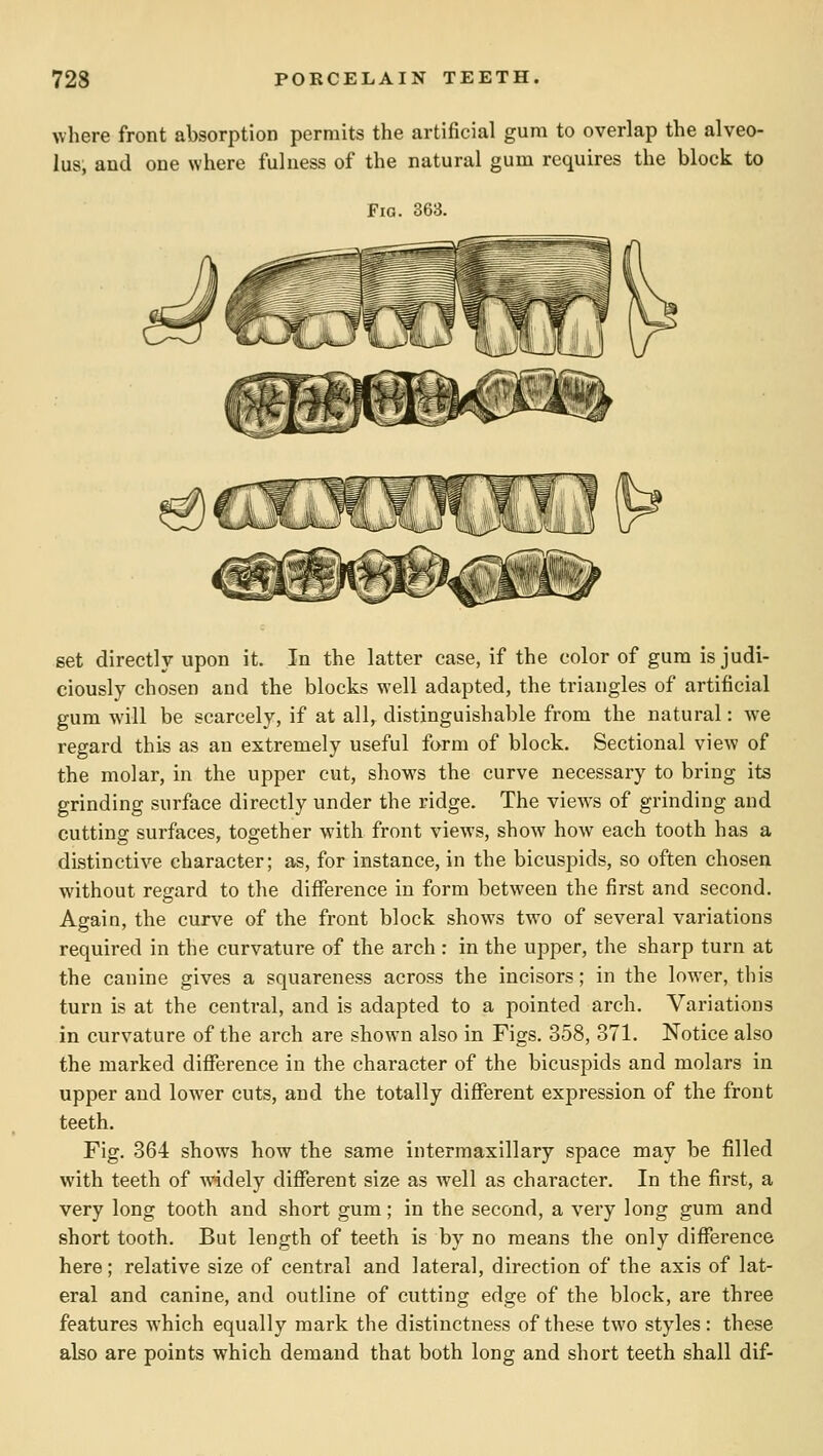where front absorption permits the artificial gum to overlap the alveo- lus, and one where fulness of the natural gum requires the block to Fia. 363. set directly upon it. In the latter case, if the color of gum is judi- ciously chosen and the blocks well adapted, the triangles of artificial gum will be scarcely, if at all, distinguishable from the natural: we regard this as an extremely useful form of block. Sectional view of the molar, in the upper cut, shows the curve necessary to bring its grinding surface directly under the ridge. The views of grinding and cutting surfaces, together with front views, show how each tooth has a distinctive character; as, for instance, in the bicuspids, so often chosen without regard to the diflTerence in form between the first and second. Again, the curve of the front block shows two of several variations required in the curvature of the arch: in the upper, the sharp turn at the canine gives a squareness across the incisors; in the lower, this turn is at the central, and is adapted to a pointed arch. Variations in curvature of the arch are shown also in Figs. 358, 371. Notice also the marked diflTerence in the character of the bicuspids and molars in upper and lower cuts, and the totally different expression of the front teeth. Fig. 364 shows how the same intermaxillary space may be filled with teeth of mdely different size as well as character. In the first, a very long tooth and short gum; in the second, a very long gum and short tooth. But length of teeth is by no means the only difference here; relative size of central and lateral, direction of the axis of lat- eral and canine, and outline of cutting edge of the block, are three features which equally mark the distinctness of these two styles: these also are points which demand that both long and short teeth shall dif-
