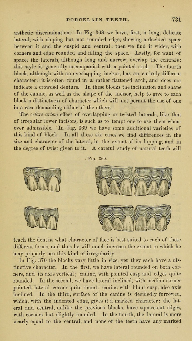 sesthetic discrimination. In Fig. 368 we have, first, a long, delicate lateral, with sloping but not rounded edge, showing a decided space between it and the cuspid and central: then we find it wider, with corners and edge rounded and filling the space. Lastly, for want of space, the laterals, although long and narrow, overlap the centrals: this style is generally accompanied with a pointed arch. The fourth block, although with an overlapping incisor, has an entirely different character: it is often found in a rather flattened arch, and does not indicate a crowded denture. In these blocks the inclination and shape of the canine,- as well as the shape of the incisor, help to give to each block a distinctness of character which will not permit the use of one in a case demanding either of the others. The celare artem effect of overlapping or twisted laterals, like that of irregular lower incisors, is such as to tempt one to use them when- ever admissible. In Fig. 369 we have some additional varieties of this kind of block. In all these six cases we find differences in the size and character of the lateral, in the extent of its lapping, and in the degree of twist given to it. A careful study of natural teeth will • Fig. 369. teach the dentist what character of face is best suited to each of these dififerent forms, and thus he will much increase the extent to which he may properly use this kind of irregularity. In Fig. 370 the blocks vary little in size, yet they each have a dis- tinctive character. In the first, we have lateral rounded on both cor- ners, and its axis vertical; canine, with pointed cusp and edges quite rounded. In the second, we have lateral inclined, with median corner pointed, lateral corner quite round ; canine with blunt cusp, also axis inclined. In the third, surface of the canine is decidedly furrowed, which, with the indented edge, gives it a marked character: the lat- eral and central, unlike the previous blocks, have square-cut edges, with corners but slightly rounded. In the fourth, the lateral is more nearly equal to the central, and none of the teeth have any marked