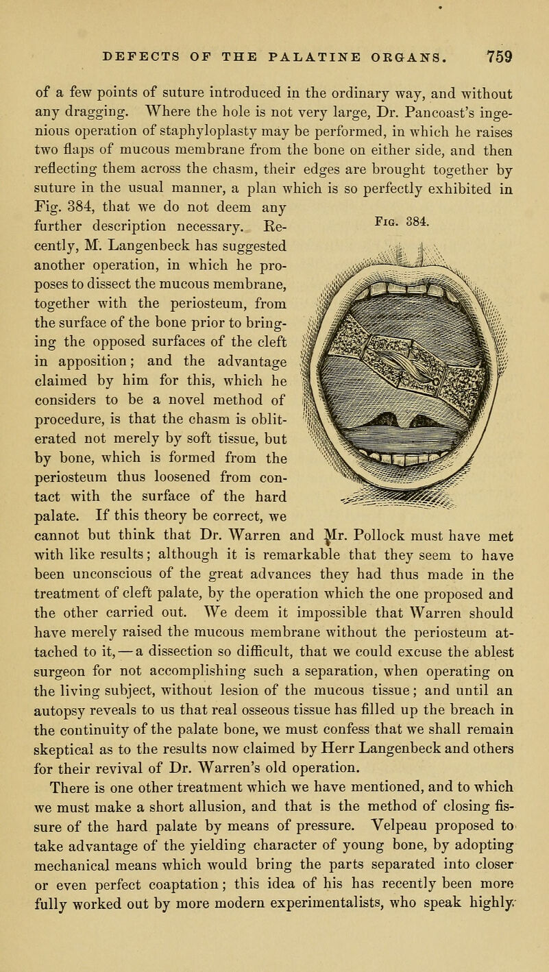 Fig. 384. of a few points of suture introduced in the ordinary way, and without any dragging. Where the hole is not very large, Dr. Pancoast's inge- nious operation of staphyloplasty may be performed, in which he raises two flaps of mucous membrane from the bone on either side, and then reflecting them across the chasm, their edges are brought together by suture in the usual manner, a plan which is so perfectly exhibited in Fig. 384, that we do not deem any further description necessary. Re- cently, M. Langenbeck has suggested another operation, in which he pro- poses to dissect the mucous membrane, together with the periosteum, from the surface of the bone prior to bring- ing the opposed surfaces of the cleft in apposition; and the advantage claimed by him for this, which he considers to be a novel method of procedure, is that the chasm is oblit- erated not merely by soft tissue, but by bone, which is formed from the periosteum thus loosened from con- tact with the surface of the hard palate. If this theory be correct, we cannot but think that Dr. Warren and ^r. Pollock must have met with like results; although it is remarkable that they seem to have been unconscious of the great advances they had thus made in the treatment of cleft palate, by the operation which the one proposed and the other carried out. We deem it impossible that Warren should have merely raised the mucous membrane without the periosteum at- tached to it, — a dissection so difficult, that we could excuse the ablest surgeon for not accomplishing such a separation, when operating on the living subject, without lesion of the mucous tissue; and until an autopsy reveals to us that real osseous tissue has filled up the breach in the continuity of the palate bone, we must confess that we shall remain skeptical as to the results now claimed by Herr Langenbeck and others for their revival of Dr. Warren's old operation. There is one other treatment which we have mentioned, and to which we must make a short allusion, and that is the method of closing fis- sure of the hard palate by means of pressure. Velpeau proposed tO' take advantage of the yielding character of young bone, by adopting mechanical means Avhich would bring the parts separated into closer or even perfect coaptation; this idea of his has recently been more fully worked out by more modern experimentalists, who speak highly.