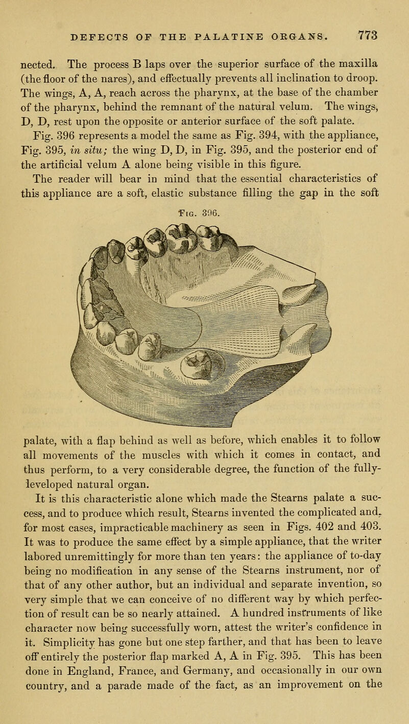 nected. The process B laps over the superior surface of the maxilla (the floor of the nares), and effectually prevents all inclination to droop. The wings, A, A, reach across the pharynx, at the base of the chamber of the pharynx, behind the remnant of the natural velum. The wings, D, D, rest upon the opposite or anterior surface of the soft palate. Fig. 396 represents a model the same as Fig. 394, with the appliance. Fig. 395, in situ; the wing D, D, in Fig. 395, and the posterior end of the artificial velum A alone being visible in this figure. The reader will bear in mind that the essential characteristics of this appliance are a soft, elastic substance filling the gap in the soft Fig. 396. palate, with a flap behind as well as before, which enables it to follow all movements of the muscles with which it comes in contact, and thus perform, to a very considerable degree, the function of the fully- ieveloped natural organ. It is this characteristic alone which made the Stearns palate a suc- cess, and to produce which result, Stearns invented the complicated and. for most cases, impracticable machinery as seen in Figs, 402 and 403. It was to produce the same effect by a simple appliance, that the writer labored unremittingly for more than ten years: the appliance of to-day being no modification in any sense of the Stearns instrument, nor of that of any other author, but an individual and separate invention, so very simple that we can conceive of no different way by which perfec- tion of result can be so nearly attained. A hundred instruments of like character now being successfully worn, attest the writer's confidence in it. Simplicity has gone but one step farther, and that has been to leave off* entirely the posterior flap marked A, A in Fig. 395. This has been done in England, France, and Germany, and occasionally in our own country, and a parade made of the fact, as an improvement on the