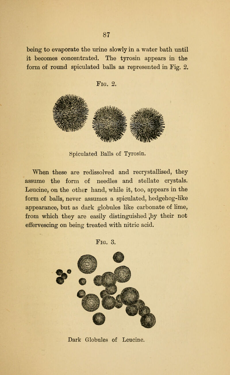 being to evaporate the urine slowly in a water bath until it becomes concentrated. The tyrosin appears in the form of round spiculated balls as represented in Fig. 2. Fig. 2. Spiculated Balls of Tyrosin. When these are redissoived and recrystaUised, they assume the form of needles and stellate crystals. Leucine, on the other hand, while it, too, appears in the form of balls, never assumes a spiculated, hedgehog-like appearance, but as dark globules like carbonate of hme, from which they are easily distinguished jby their not effervescing on being treated with nitric acid. Fig. 3. y Dark Globules of Leucine.