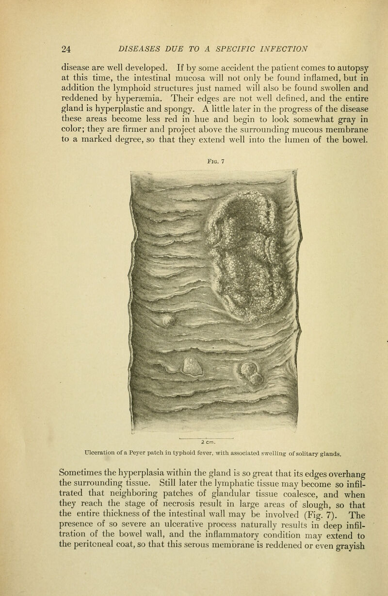 disease are well developed. If by some accident the patient comes to autopsy at this time, the intestinal mucosa will not only be found inflamed, but in addition the lymphoid structures just named will also be found swollen and reddened by hypersemia. Their edges are not well defined, and the entire gland is hyperplastic and spongy. A little later in the progress of the disease these areas become less red in hue and begin to look somewhat gray in color; they are firmer and project above the surrounding mucous membrane to a marked degree, so that they extend well into the lumen of the bowel. Fig. 7 Ulceration of a Peyer patch in typhoid fever, with associated swelling of soUtary glands. Sometimes the hyperplasia within the gland is so great that its edges overhang the surrounding tissue. Still later the lymphatic tissue may become so infil- trated that neighboring patches of glandular tissue coalesce, and when they reach the stage of necrosis result in large areas of slough, so that the entire thickness of the intestinal wall may be involved (Fig. 7), The presence of so severe an ulcerative process naturally results in deep infil- tration of the bowel wall, and the inflammatory condition may extend to the peritoneal coat, so that this serous membrane is reddened or even grayish