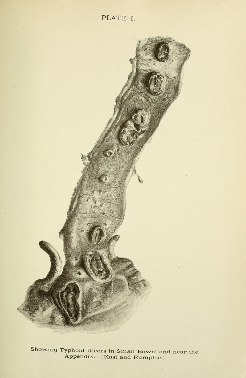 PLATE I. Showing Typhoid Ulcers in Small Bowel and near the Appendix. (Kast and Rumpler.)