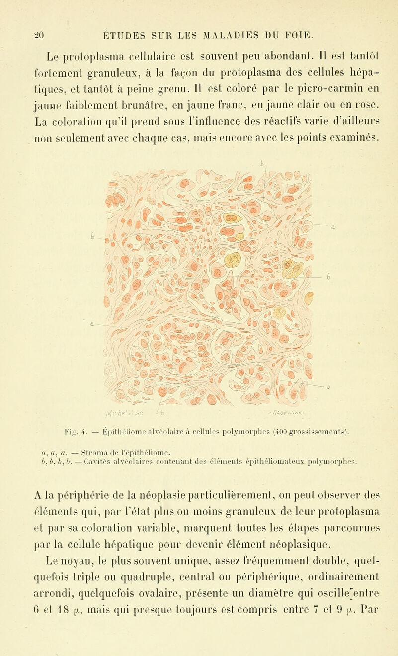 Le protoplasma cellulaire est souvent peu abondant. Il est tantôt forlement granuleux, à la façon du protoplasma des cellules hépa- tiques, et tantôt à peine grenu. Il est coloré par le picro-carmin en jaune faiblement brunâtre, en jaune franc, en jaune clair ou en rose. La coloration qu'il prend sous l'influence des réactifs varie d'ailleurs non seulement avec chaque cas, mais encore avec les points examinés. sLyy-' /, Fig. 4. — ÉpitluMiome alvéolaire à cellules polymorphes (400 grossissements). «, fl, a. — Stroma de l'épithéliome. b, b, h, h. — Cavités alvéolaires contenant des éléments épithéliomateux polymorphes. A la périphérie de la néoplasie particulièrement, on peut observer des éléments qui, par l'état plus ou moins granuleux de leur protoplasma et par sa coloration variable, marquent toutes les étapes parcourues par la cellule hépatique pour devenir élément néoplasique. Le noyau, le plus souvent unique, assez fréquemment double, quel- quefois triple ou quadruple, central ou périphérique, ordinairement arrondi, quelquefois ovalaire, présente un diamètre qui oscille'enlre G et 18 p., mais qui presque toujours est compris entre 7 et 9 a. Par