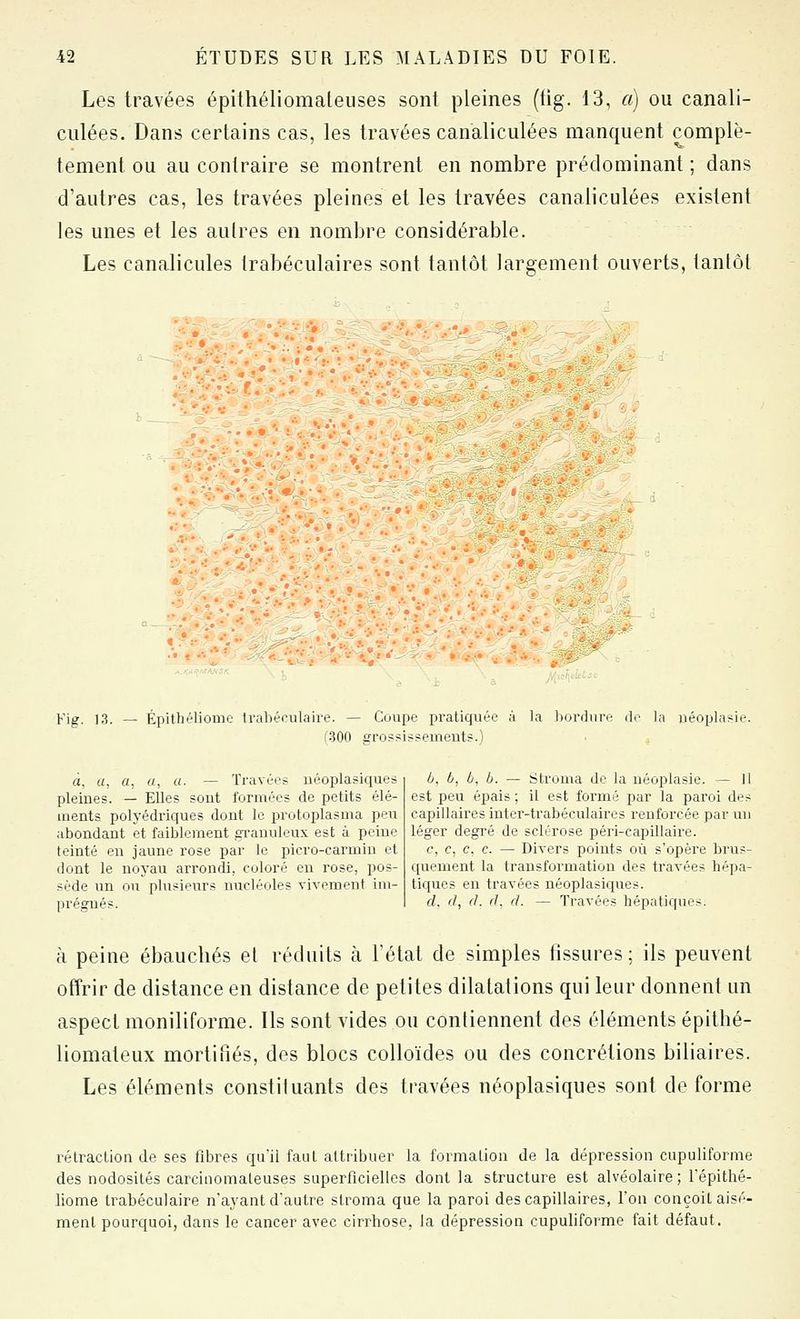 Les travées épithéliomateuses sont pleines (fig. 13, a) ou canali- ciilées. Dans certains cas, les travées canaliculées manquent complè- tement ou au contraire se montrent en nombre prédominant ; dans d'autres cas, les travées pleines et les travées canaliculées existent les unes et les autres en nombre considérable. Les canalicules trabéculaires sont tantôt largement ouverts, tantôt iv^'^'^oïf^/ ; • • ••. . ■ • •: • : r: '>>:^^ i:*;** Fig. 13. — Épithéliomo trabérulaire. — Coupe pratiquée à la bordure de la uéoplai^ie. f-SOO gro?>i??emeuts.) à, a, «, a, a. — Travées néoplasiques pleines. — Elles sout formées de petits élé- ments polyédriques dont le protoplasma peu abondant et faiblement granuleux est à peine teinté en jaune rose par le picro-carmiu et dont le noyau arrondi, coloré en rose, pos- sède un ou plusipurs mwléoles vivement im- prégnés. b, ô, b, h. — Stroma de la néoplasie. — 11 est peu épais ; il est formé par la paroi des capillaires iuter-trabéculaires renforcée par un léger degré de sclérose péri-capillaire. c, c, c, c. — Divers points où s'opère brus- quement la transformation des travées hépa- tiques en travées néoplasiques. d, ri, (1. (1. d. — Travées hépatiques. à peine ébauchés et réduits à Tétai de simples fissures; ils peuvent offrir de distance en distance de petites dilatations qui leur donnent un aspect moniliforme. Ils sont vides ou contiennent des éléments épithé- liomateux mortiiiés, des blocs colloïdes ou des concrétions biliaires. Les éléments constituants des travées néoplasiques sont déforme rétraction de ses fibres qu'il faut attribuer la formation de la dépression cupuliforme des nodosités carcinomateuses superficielles dont la structure est alvéolaire; Tépithé- liome trabéculaire n'ayant dautre stroma que la paroi des capillaires, l'on conçoit aisé- ment pourquoi, dans le cancer avec cirrhose, la dépression cupuliforme fait défaut.