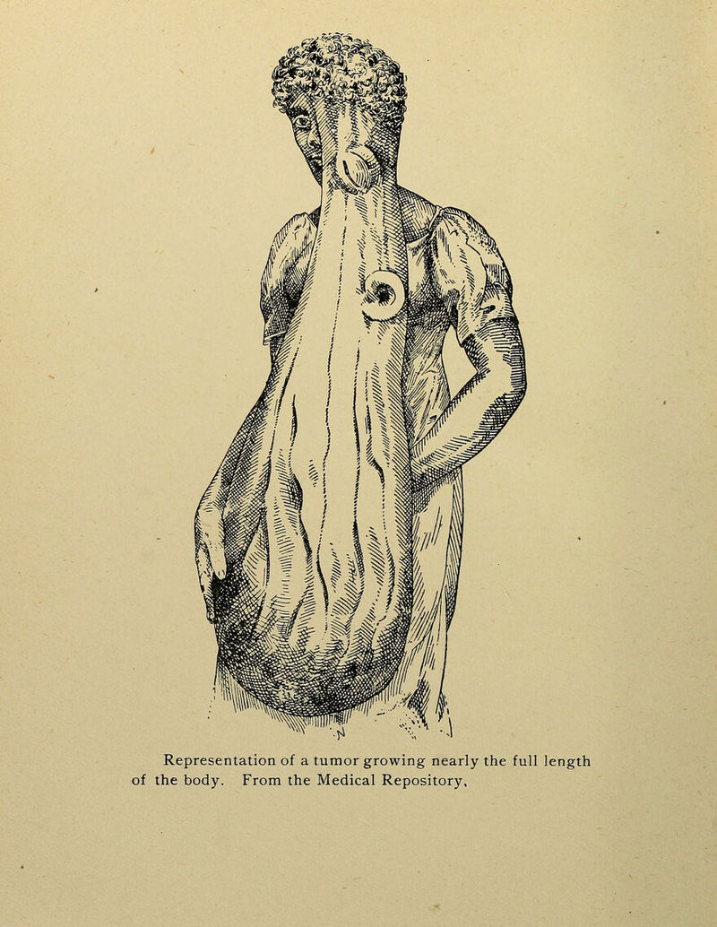 Representation of a tumor growing nearly the full length of the body. From the Medical Repository,