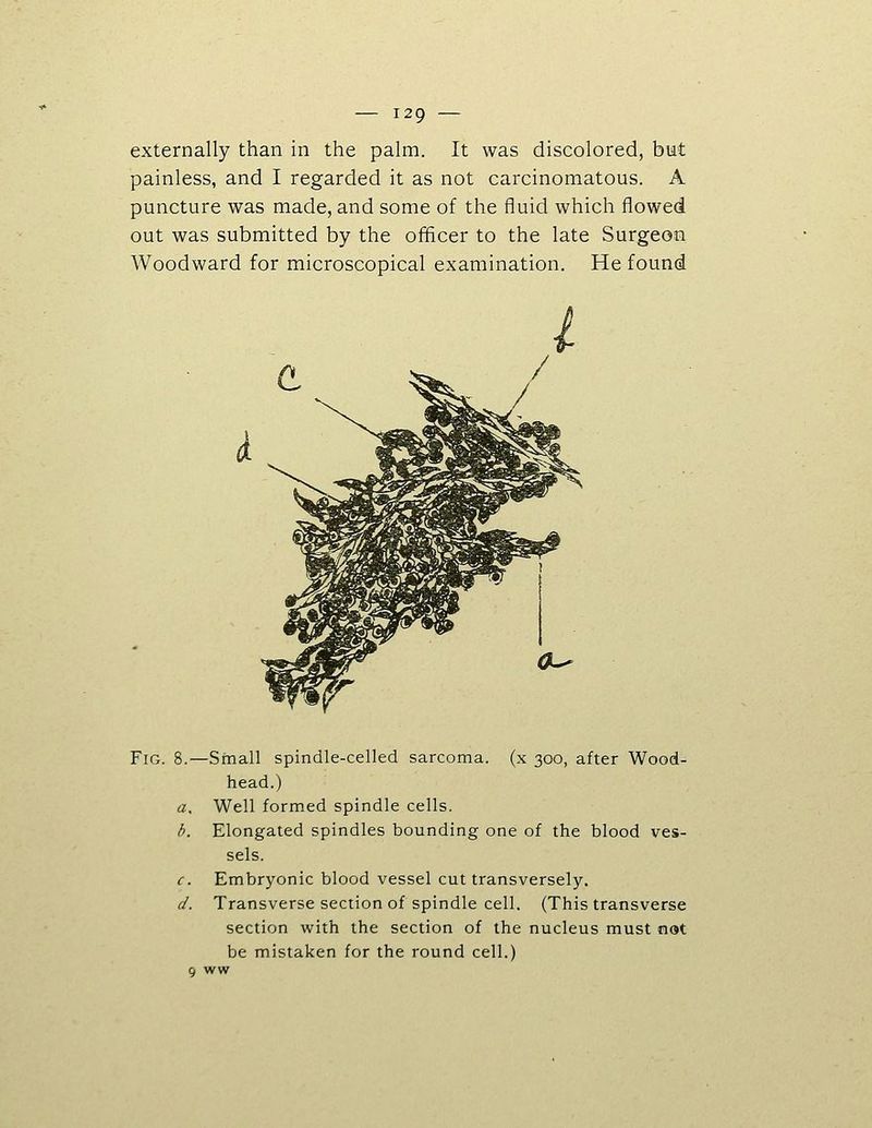 externally than in the palm. It was discolored, but painless, and I regarded it as not carcinomatous. A puncture was made, and some of the fluid which flowed out was submitted by the officer to the late Surgeon Woodward for microscopical examination. He found Fig. 8.—Small spindle-celled sarcoma, (x 300, after Wood- head.) a. Well formed spindle cells. b. Elongated spindles bounding one of the blood ves- sels. c. Embryonic blood vessel cut transversely. d. Transverse section of spindle cell. (This transverse section with the section of the nucleus must nat be mistaken for the round cell.) 9 WW
