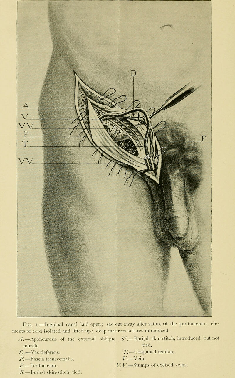 Fig. I.—Inguinal canal laid open; sac cut away after suture of the peritona;um ; ele- ments of cord isolated and lifted up; deep mattress sutures introduced. A.—-Aponeurosis of the external oblique S'.—Buried skin-stitch, introduced but not muscle. tied. D.—Vas deferens. T.—Conjoined tendon. F.—Fascia transversalis. V.—Vein. P.—Peritonreum. V. V.—Stumps of excised veins. 5*.—Buried skin-stitch, tied.