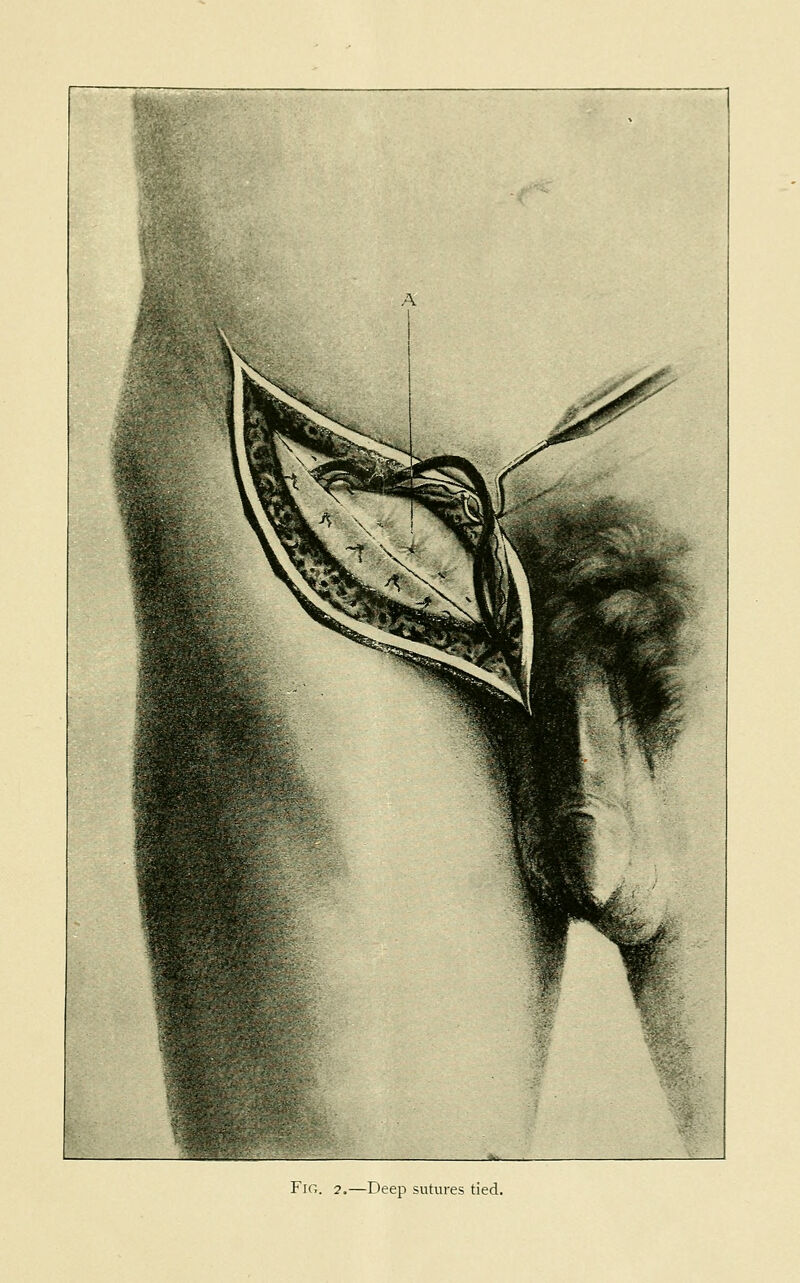 Fig. 2.—Deep sutures tied.