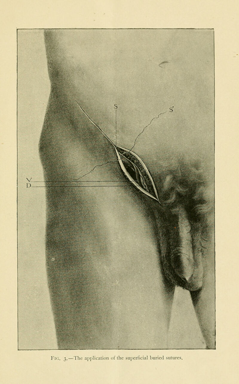 Fig. 3.—The application of the superficial buried sutures.