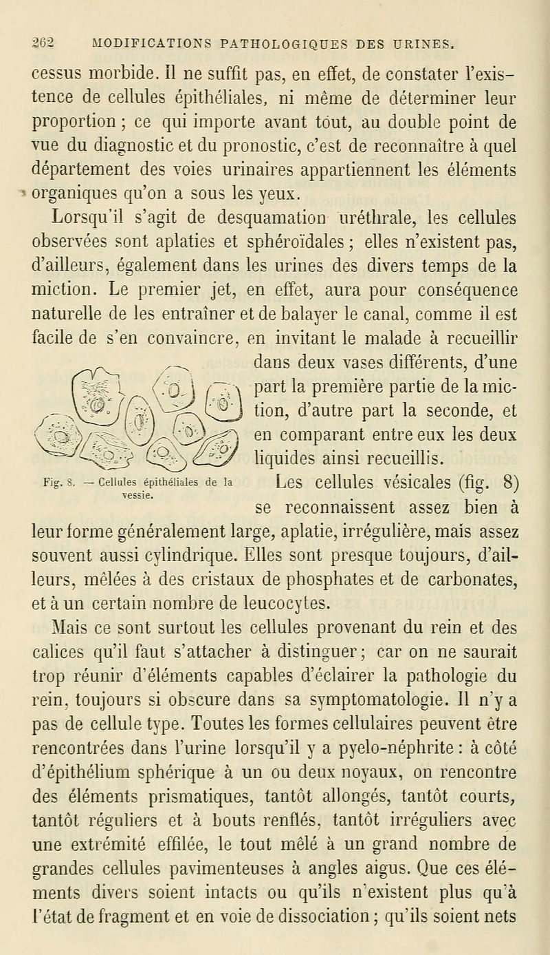 cessus morbide. Il ne suffit pas, en effet, de constater l'exis- tence de cellules épithéliales, ni même de déterminer leur proportion ; ce qui importe avant tout, au double point de vue du diagnostic et du pronostic, c'est de reconnaître à quel département des voies urinaires appartiennent les éléments organiques qu'on a sous les yeux. Lorsqu'il s'agit de desquamation uréthrale, les cellules observées sont aplaties et sphéroïdales ; elles n'existent pas, d'ailleurs, également dans les urines des divers temps de la miction. Le premier jet, en effet, aura pour conséquence naturelle de les entraîner et de balayer le canal, comme il est facile de s'en convaincre, en invitant le malade à recueillir dans deux vases différents, d'une part la première partie de la mic- tion, d'autre part la seconde, et en comparant entre eux les deux liquides ainsi recueillis. Fig. 8. - Cellules épithéliales de la LcS CellulCS véslcalcS (flg. 8) se reconnaissent assez bien à leur forme généralement large, aplatie, irrégulière, mais assez souvent aussi cylindrique. Elles sont presque toujours, d'ail- leurs, mêlées à des cristaux de phosphates et de carbonates, et à un certain nombre de leucocytes. Mais ce sont surtout les cellules provenant du rein et des calices qu'il faut s'attacher à distinguer; car on ne saurait trop réunir d'éléments capables d'éclairer la pathologie du rein, toujours si obscure dans sa symptomatologie. Il n'y a pas de cellule type. Toutes les formes cellulaires peuvent être rencontrées dans l'urine lorsqu'il y a pyelo-néphrite : à côté d'épithélium sphérique à un ou deux noyaux, on rencontre des éléments prismatiques, tantôt allongés, tantôt courts, tantôt réguliers et à bouts renflés, tantôt irréguliers avec une extrémité effilée, le tout mêlé à un grand nombre de grandes cehules pavimenteuses à angles aigus. Que ces élé- ments divers soient intacts ou qu'ils n'existent plus qu'à l'état de fragment et en voie de dissociation ; qu'ils soient nets