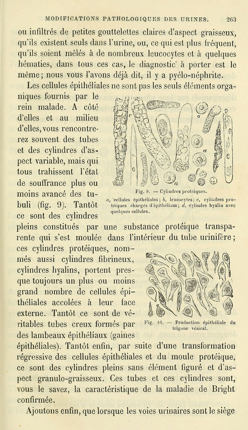 OU infiltrés de petites gouttelettes claires d'aspect graisseux, qu'ils existent seuls dans l'urine, ou, ce qui est plus fréquent, qu'ils soient mêlés à de nombreux leucocytes et à quelques hématies, dans tous ces cas, le diagnostic à porter est le même; nous vous l'avons déjà dit, il y a pyélo-néphrite. Les cellules épithéliales ne sont pas les seuls éléments orga- niques fournis par le rein malade. A côté d'elles et au milieu d'elles, vous rencontre- rez souvent des tubes et des cylindres d'as- pect variable, mais qui tous trahissent l'état de souffrance plus ou moins avancé des tu- buli (fig. 9j. Tantôt ce sont des cylindres pleins constitués par Fig 9 — Cjlmdies pioteiques ,'cellules épithéliales ; 6, leucocytes; c, cylindres pro- téiques chargés d'épithéliurn; d, cylindre hyalin avec quelques cellules. une substance protéique transpa- rente qui s'est moulée dans l'intérieur du tube urinifère ; ces cyhndres protéiques, nom- més aussi cylindres fibrineux, cyhndres hyalins, portent pres- que toujours un plus ou moins grand nombre de cellules épi- théliales accolées à leur face externe. Tantôt ce sont de vé- ritables tubes creux formés par des lambeaux épithéliaux (gaines épithéliales). Tantôt enfin, par suite d'une transformation régressive des cellules épithéliales et du moule protéique, ce sont des cylindres pleins sans élément figuré et d'as- pect granulo-graisseux. Ces tubes et ces cylindres sont, vous le savez, la caractéristique de la maladie de Bright confirmée. Ajoutons enfin, que lorsque les voies urinaires sont le siège Fig. 10. Production épithéliale du trigone ■vésical.