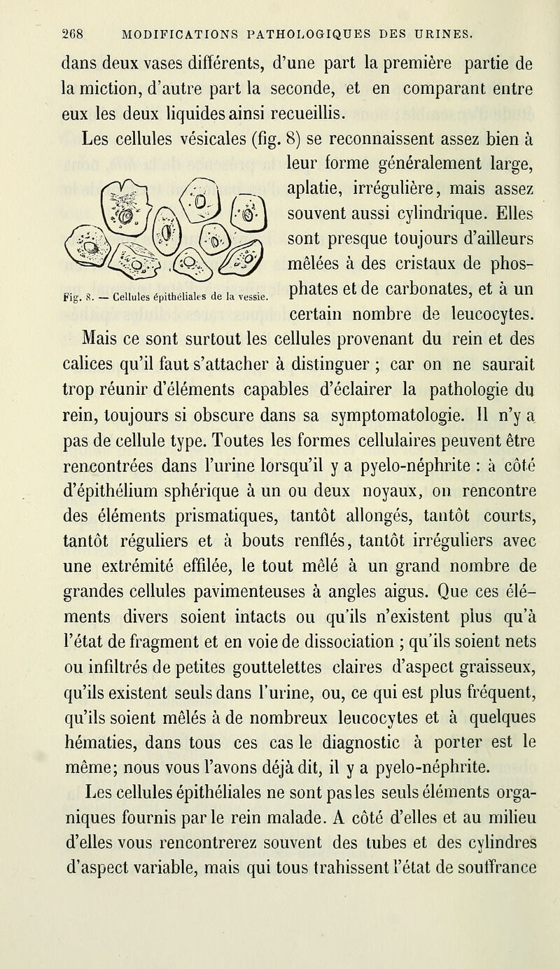 Fig. S. — Cellules épithéliales de la vessie. dans deux vases différents, d'une part la première partie de la miction, d'autre part la seconde, et en comparant entre eux les deux liquides ainsi recueillis. Les cellules vésicales (fig. 8) se reconnaissent assez bien à leur forme généralement large, aplatie, irrégulière, mais assez souvent aussi cylindrique. Elles sont presque toujours d'ailleurs mêlées à des cristaux de phos- phates et de carbonates, et à un certain nombre de leucocytes. Mais ce sont surtout les cellules provenant du rein et des calices qu'il faut s'attacher à distinguer ; car on ne saurait trop réunir d'éléments capables d'éclairer la pathologie du rein, toujours si obscure dans sa symptomatologie. 11 n'y a pas de cellule type. Toutes les formes cellulaires peuvent être rencontrées dans l'urine lorsqu'il y a pyelo-néphrite : à côté d'épithélium sphérique à un ou deux noyaux, on rencontre des éléments prismatiques, tantôt allongés, tantôt courts, tantôt réguliers et à bouts renflés, tantôt irréguliers avec une extrémité effilée, le tout mêlé à un grand nombre de grandes cellules pavimenteuses à angles aigus. Que ces élé- ments divers soient intacts ou qu'ils n'existent plus qu'à l'état de fragment et en voie de dissociation ; qu'ils soient nets ou infiltrés de petites gouttelettes claires d'aspect graisseux, qu'ils existent seuls dans l'urine, ou, ce qui est plus fréquent, qu'ils soient mêlés à de nombreux leucocytes et à quelques hématies, dans tous ces cas le diagnostic à porter est le même; nous vous l'avons déjà dit, il y a pyelo-néphrite. Les cellules épithéliales ne sont pas les seuls éléments orga- niques fournis parle rein malade. A côté d'elles et au milieu d'elles vous rencontrerez souvent des tubes et des cylindres d'aspect variable, mais qui tous trahissent l'état de soutTrance