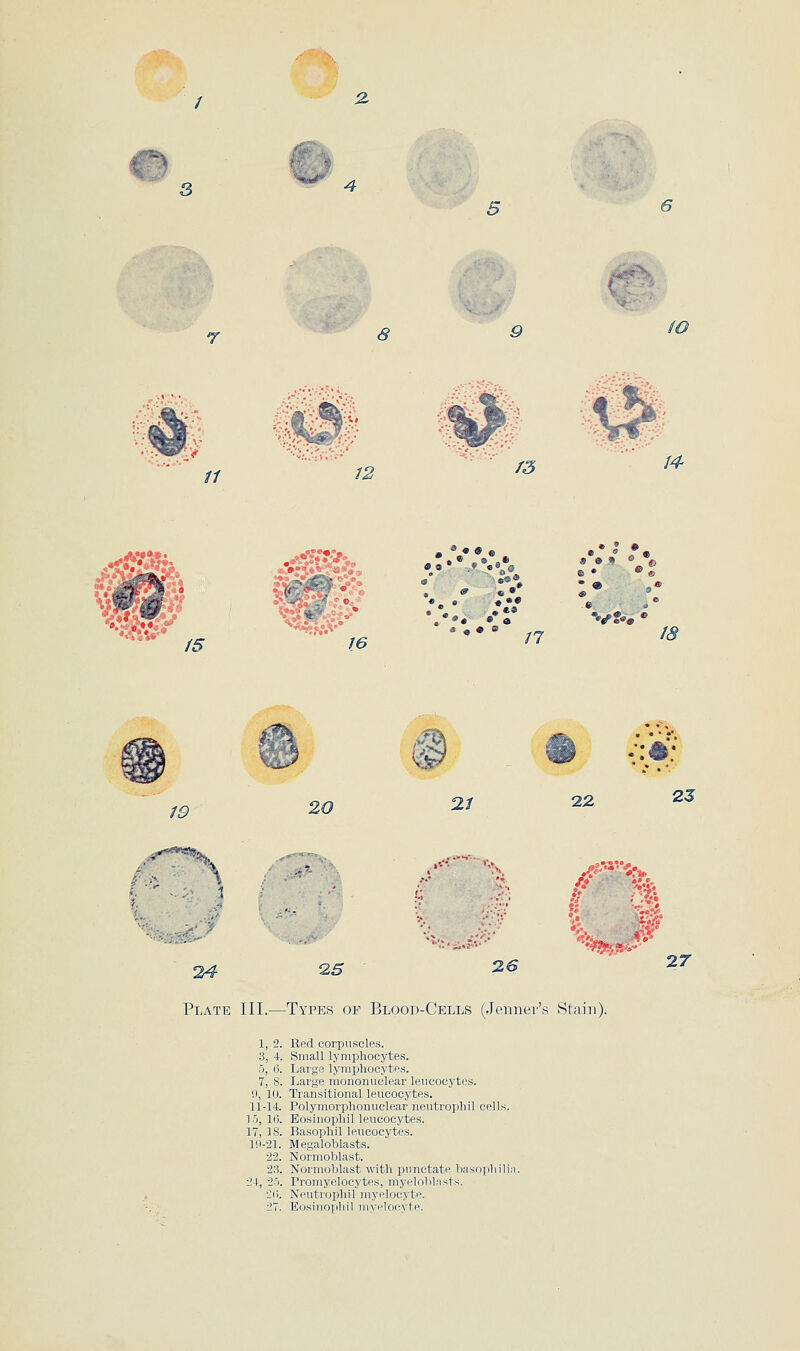 3 4 ^j^rix ro 11 12 /3 14 /5 , ^'*'9 16 »•*« «0< a 4 • a n v?«» /c^ /£? 20 2/ 22 2J 24 .•^^■'^s 3^ *''^f.% 4 > 2r Plate III.—Types of Blood-Cells (.Tenner's Stain). 1, 2. Red corpuscles. 3, 4. Small lymphocytes. 5, 6. Large lymphocytes. 7, 8. Large mononuclear leucocytes. 9, 10. Transitional leucocytes. 11-14. Polymorphonuclear neutrophil cells. 15, 10. Eosinophilleuoocytes. 17, IS. Basophil leucocytes. 19-21. Megaloblasts. 22. Normoblast. 23. Normoblast with punctate basoyilnlin. ■24, 2-'i. Promyelocytes, myelobliists. ill. Neutrophil myelocyte. 2T. Eosi)iO]iliil iiiNi'locyte.