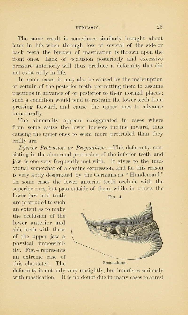 The same result is sometimes similarly brought about later in life, when through loss of several of the side or back teeth the burden of mastication is thrown upon the front ones. Lack of occlusion posteriorly and excessive pressure anteriorly will thus produce a deformity that did not exist early in life. In some cases it may also be caused by the maleruption of certain of the jDOsterior teeth, permitting them to assume positions in advance of or posterior to their normal places; such a condition would tend to restrain the lower teeth from pressing forward, and cause the upper ones to advance unnaturally. The abnormity appears exaggerated in cases where from some cause the lower incisors incline inward, thus causing the upper ones to seem more protruded than they really are. Inferior Protrusion or Prognathism.—This deformity, con- sisting in the abnormal protrusion of the inferior teeth and jaw, is one very frequently met with. It gives to the indi- vidual somewhat of a canine expression, and for this reason is very aptly designated by the Germans as  Hundemaul. In some cases the lower anterior teeth occlude with the superior ones, but j^ass outside of them, while in others the lower jaw and teeth are protruded to such an extent as to make the occlusion of the lower anterior and side teeth with those of the upper jaw a physical impossibil- ity. Fig. 4 represents an extreme case of this character. The Prognathism, deformity is not only very unsightly, but interferes seriously with mastication. It is no doubt due in many cases to arrest Fig. 4.