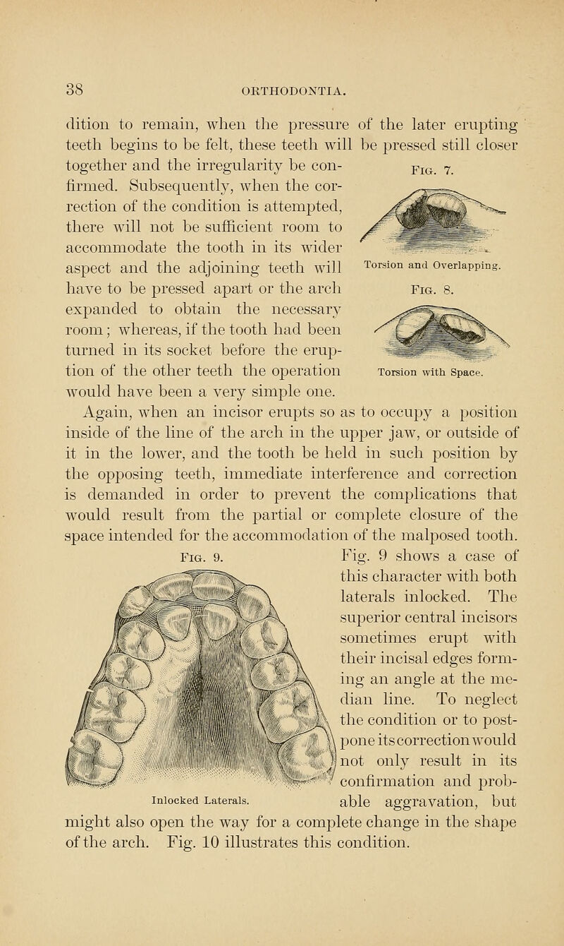 Torsion and Overlapping Fig. 8. dition to remain, when the pressure of the later erupting teeth begins to be felt, these teeth will be pressed still closer together and the irregularity be con- pj(j -7 firmed. Subsequently, when the cor- rection of the condition is attempted, there will not be sufficient room to accommodate the tooth in its wider aspect and the adjoining teeth will have to be pressed apart or the arch expanded to obtain the necessary room; whereas, if the tooth had been turned in its socket before the erup- tion of the other teeth the operation Torsion witti spacf. would have been a very simple one. Again, when an incisor erupts so as to occupy a position inside of the line of the arch in the upper jaw, or outside of it in the lower, and the tooth be held in such position by the opposing teeth, immediate interference and correction is demanded in order to prevent the complications that would result from the partial or complete closure of the space intended for the accommodation of the malposed tooth. Fig. 9 shows a case of this character with both laterals inlocked. The superior central incisors sometimes erupt with their incisal edges form- ing an angle at the me- dian line. To neglect the condition or to post- pone its correction would not only result in its confirmation and prob- able aggravation, but might also open the way for a complete change in the shape of the arch. Fig. 10 illustrates this condition. Inlocked Laterals.