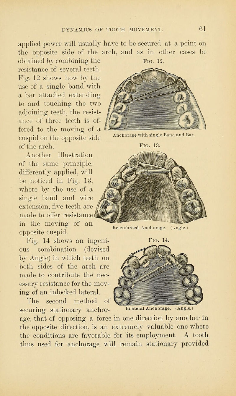 Fig. 13. Anchorage with single Band and Bar. Fig. 13. applied power will usually have to be secured at a point on the opposite side of the arch, and as in other cases be obtained by combining the resistance of several teeth. Fig. 12 shows how by the use of a single band with a bar attached extending to and touching the two adjoining teeth, the resist- ance of three teeth is of- fered to the moving of a cuspid on the opj)Osite side of the arch. Another illustration of the same principle, differently applied, will be noticed in Fig. 13, where by the use of a single band and wire extension, five teeth are made to offer resistance in the moving of an opposite cuspid. Fig. 11 shows an ingeni- ous combination (devised by Angle) in which teeth on both sides of the arch are made to contribute the nec- essary resistance for the mov- ing of an inlocked lateral. The second method of ________^ securing stationary anchor- Bllateral Anchorage. (Angle.) age, that of opposing a force in one direction by another in the opposite direction, is an extremely valuable one where the conditions are favorable for its employment. A tooth thus used for anchorage will remain stationary provided Re-entorced Anchorage. ( ingle.) Fig. 14.