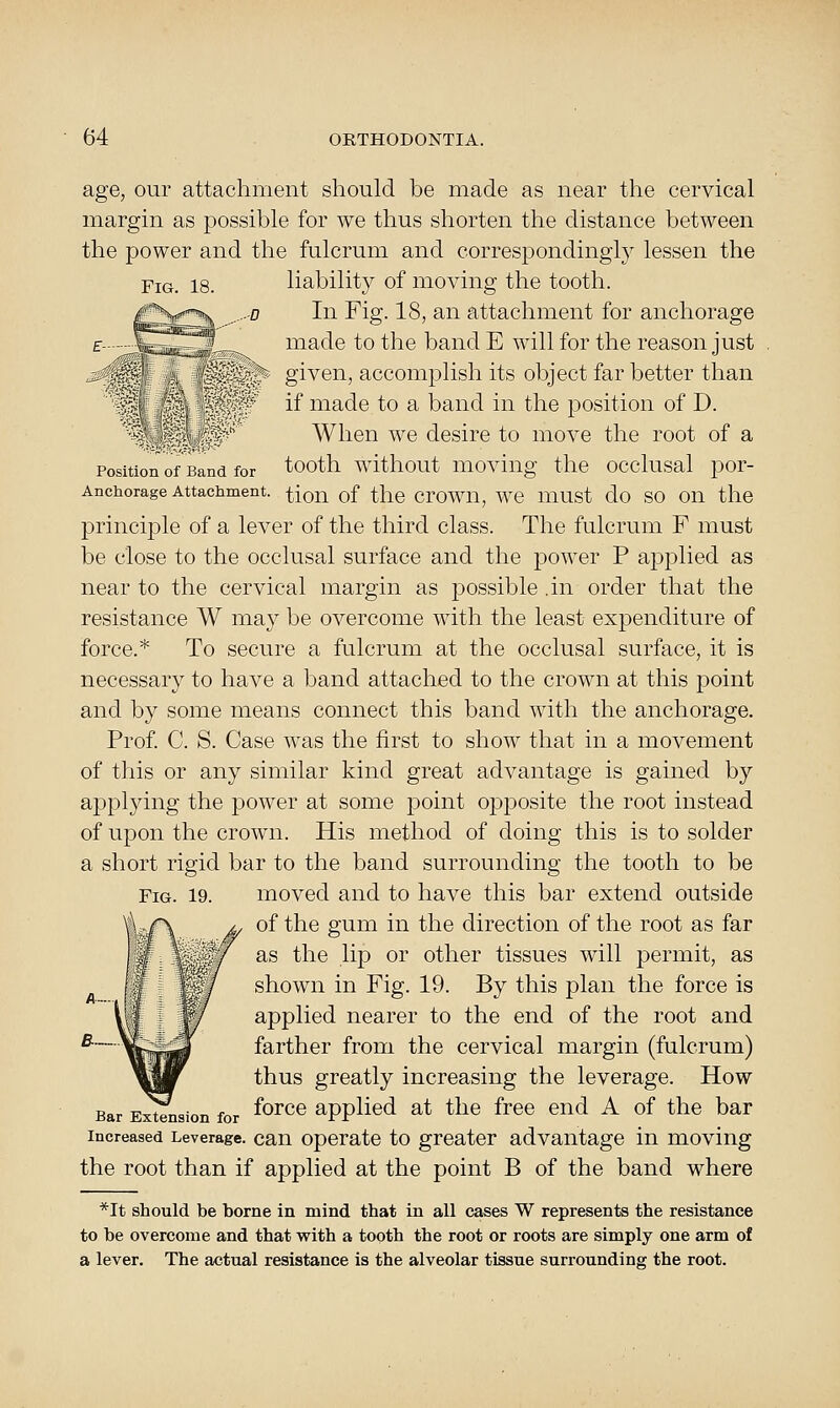 Position of Band for Anchorage Attachment age, our attachment should be made as near the cervical margin as possible for we thus shorten the distance between the power and the fulcrum and correspondingly lessen the liability of moving the tooth. In Fig. 18, an attachment for anchorage made to the band E will for the reason just given, accomplish its object far better than if made to a band in the position of D. When we desire to move the root of a tooth without moving the occlusal por- tion of the crown, we must do so on the principle of a lever of the third class. The fulcrum F must be close to the occlusal surface and the power P applied as near to the cervical margin as possible .in order that the resistance W may be overcome with the least expenditure of force.* To secure a fulcrum at the occlusal surface, it is necessary to have a band attached to the crown at this point and by some means connect this band with the anchorage. Prof. C. S. Case was the first to show that in a movement of this or any similar kind great advantage is gained by applying the power at some j^oint opposite the root instead of upon the crown. His method of doing this is to solder a short rigid bar to the band surrounding the tooth to be Fig. 19. moved and to have this bar extend outside of the gum in the direction of the root as far as the lip or other tissues will permit, as shown in Fig. 19. By this plan the force is applied nearer to the end of the root and farther from the cervical margin (fulcrum) thus greatly increasing the leverage. How Bar Extension for ^^rcc applied at the free end A of the bar Increased Leverage, can Operate to greater advantage in moving the root than if applied at the point B of the band where *It should be borne in mind that in all cases W represents the resistance to be overcome and that vrith a tooth the root or roots are simply one arm of a lever. The actual resistance is the alveolar tissue surrounding the root.