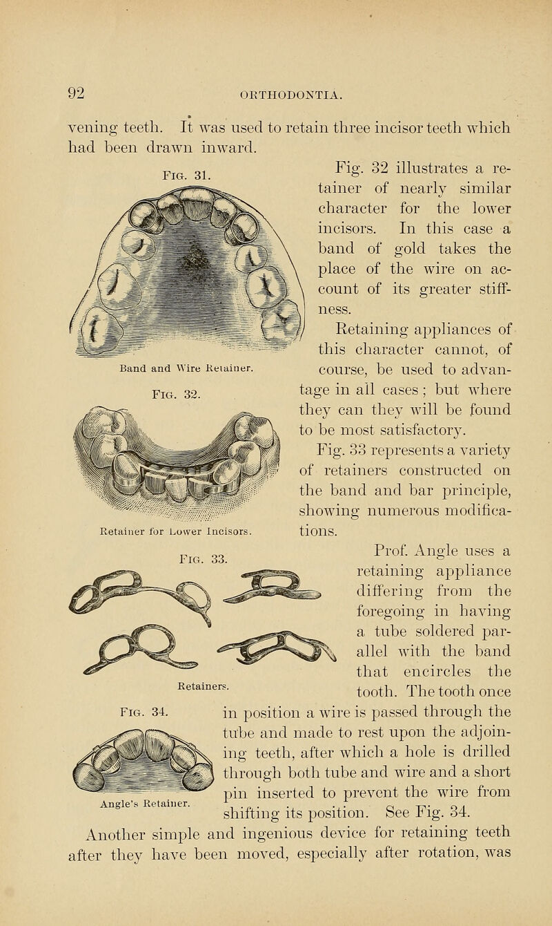 Band and ^^lre Keiamer Fig. 32. veiling teeth. It was used to retain three incisor teeth which had been drawn inward. Pj^ 3j Fig. 32 ilhistrates a re- tainer of nearly similar character for the lower incisors. In this case a band of gold takes the place of the wire on ac- count of its greater stiff- ness. Retaining appliances of this character cannot, of course, be used to advan- tage in all cases ; but where they can they will be found to be most satisfactory. Fig. 33 represents a variety of retainers constructed on the band and bar principle, showing numerous modifica- tions. Prof. Angle uses a retaining appliance differing from the foregoing in having a tube soldered par- allel with the band that encircles the tooth. The tooth once in position a wire is passed through the tube and made to rest upon the adjoin- Xf x^'^^^^pi,'^ ii^g teeth, after which a hole is drilled \ \-'^ ^^^^^^^ through both tube and wire and a short ^_^.^.=^:^E^=.^^ ^^^ inserted to prevent the wire from shifting its position. See Fig. 34. Another simple and ingenious device for retaining teeth after they have been moved, especially after rotation, was Retainer for Lower Incisors. Retainers Fig. 34. Angle's Retainer.