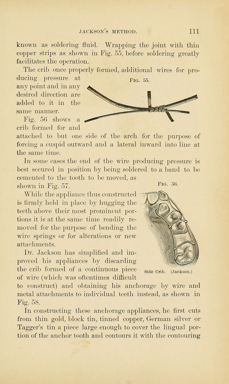 known as soldering fluid. Wrapping the joint with thin copper strips as shown in Fig. 55, before soldering greatly facilitates the operation. The crib once projDerly formed, additional wires for pro- ducing pressure at ^ yig. 55 any point and in any desired direction are added to it in the Fig. 56. same manner. Fig. 56 shows a crib formed for and attached to but one side of the arch for the purpose of forcing a cuspid outward and a lateral inward into line at the same time. In some cases the end of the wire producing pressure is best secured in position by being soldered to a band to be cemented to the tooth to be moved, as shown in Fig. 57. While the appliance thus constructed is firmly held in place by hugging the teeth above their most prominent por- tions it is at the same time readily re- moved for the purpose of bending the wire springs or for alterations or new attachments. Dr. Jackson has simplified and im- proved his api^liances by discarding the crib formed of a continuous piece of wire (which w^as oftentimes difficult to construct) and obtaining his anchorage by wire and metal attachments to individual teeth instead, as shown in Fig. 58. In constructing these anchorage appliances, he first cuts from thin gold, block tin, tinned copper, German silver or Tagger's tin a piece large enough to cover the lingual por- tion of the anchor tooth and contours it with the contouring Side Crib (Jackson )