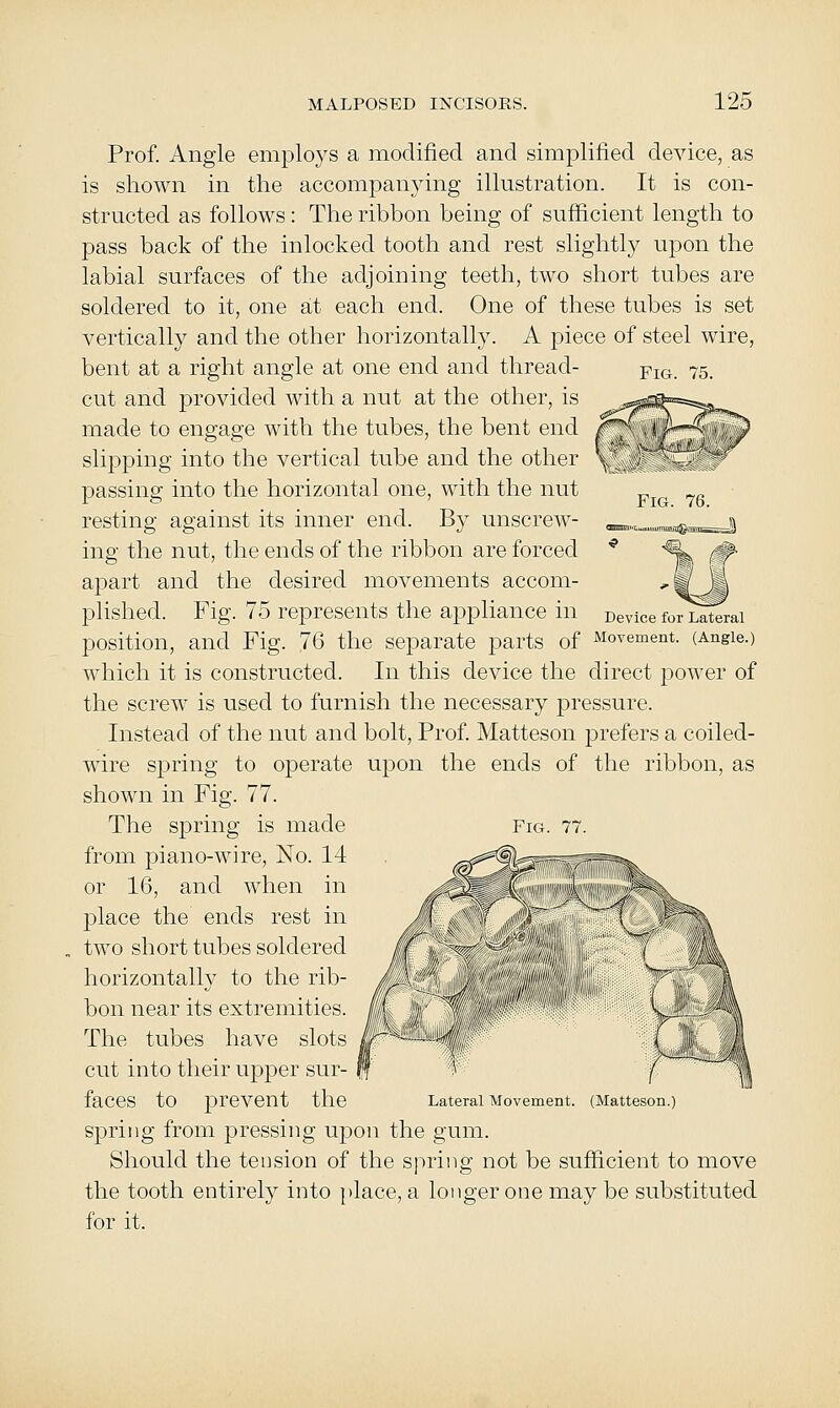 Device for Lateral Prof. Angle emplo3^s a modified and simplified device, as is shown in the accompanying illustration. It is con- structed as follows: The ribbon being of sufficient length to pass back of the inlocked tooth and rest slightly upon the labial surfaces of the adjoining teeth, two short tubes are soldered to it, one at each end. One of these tubes is set vertically and the other horizontally. A piece of steel wire, bent at a right angle at one end and thread- cut and provided with a nut at the other, is made to engage with the tubes, the bent end slipping into the vertical tube and the other passing into the horizontal one, with the nut resting against its inner end. By unscrew- ing the nut, the ends of the ribbon are forced apart and the desired movements accom- plished. Fig. 75 represents the appliance in position, and Fig. 76 the separate parts of Movement. (Angle.) which it is constructed. In this device the direct power of the screw is used to furnish the necessary pressure. Instead of the nut and bolt. Prof. Matteson prefers a coiled- wire spring to operate upon the ends of the ribbon, as shown in Fig. 77. The spring is made Fig from piano-wire. No. 14 or 16, and when in place the ends rest in two short tubes soldered horizontally to the rib- bon near its extremities. The tubes have slots cut into their upper sur- faces to prevent the Lateral Movement. (Matteson) spring from pressing upon the gum. Should the tension of the spring not be sufficient to move the tooth entirely into place, a longer one may be substituted for it.