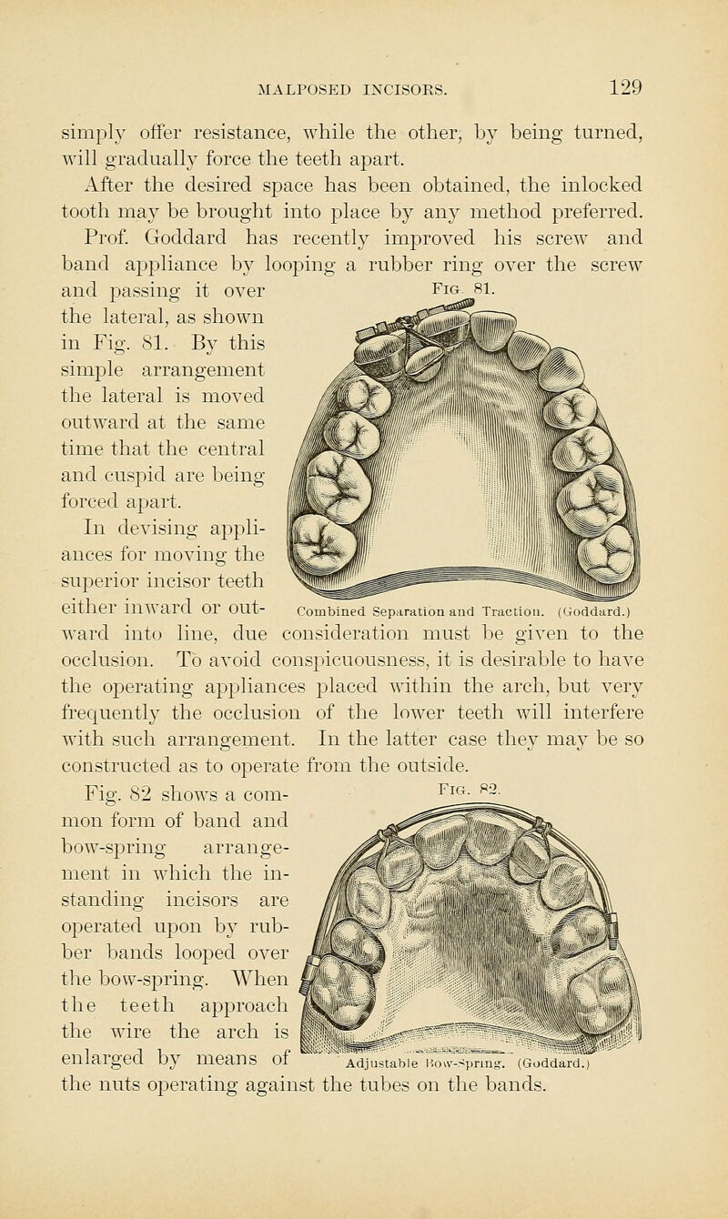 simply offer resistance, while the other, by being turned, will gradually force the teeth apart. After the desired space has been obtained, the inlocked tooth may be brought into place by any method preferred. Prof. Goddard has recently improved his screw and band appliance by looping a rubber ring over the screw and passing it over Fig 81. the lateral, as shown in Fig. SI. By this simple arrangement the lateral is moved outward at the same time that the central and cuspid are being- forced apart. In devising appli- ances for moving the superior incisor teeth either inward or out- combined separation and Traction. (Goddard.) ward into line, due consideration must be given to the occlusion. To avoid conspicuousness, it is desirable to have the operating appliances placed within the arch, but very frecjuently the occlusion of the lower teeth will interfere with such arrangement. In the latter case they may be so constructed as to operate from the outside. Fig. 82 shows a com- mon form of band and bow-spring arrange- ment in which the in- standing incisors are operated upon by rub- ber bands looped over the bow-spring. When the teeth approach the wire the arch is enlarged by means of Adiu.tahie i ..>v ^pim.. .(.add^iu) the nuts operating against the tubes on the bands. Fig. 92.