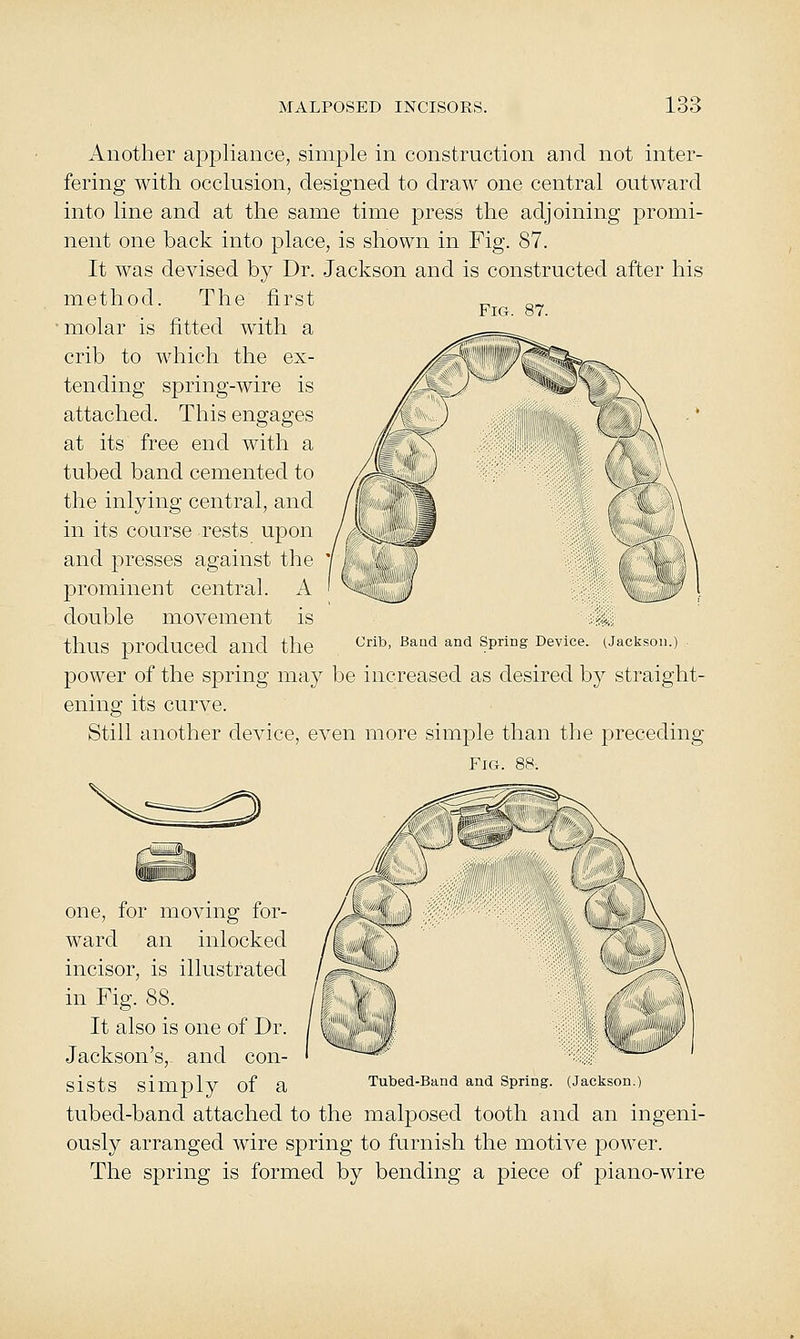 Fig. 87. Another apj^liance, simple in construction and not inter- fering with occlusion, designed to draw one central outward into line and at the same time press the adjoining promi- nent one back into place, is shown in Fig. 87. It was devised by Dr. Jackson and is constructed after his method. The first molar is fitted with a crib to which the ex- tending spring-wire is attached. This engages at its free end with a tubed band cemented to the inlying central, and in its course rests upon and presses against the prominent central. A double movement is '4„ thus produced and the ^^' ^^^^ ^^ ^^™s ^e^i°<^- (Jackson.) power of the spring may be increased as desired by straight- ening its curve. Still another device, even more simple than the preceding Fig. 88. one, for moving for- ward an inlocked incisor, is illustrated in Fig. 88. It also is one of Dr. Jackson's,- and con- sists simnlv of a Tuted-Band and Spring. (Jackson.) tubed-band attached to the malposed tooth and an ingeni- ously arranged wire spring to furnish the motive power. The spring is formed by bending a piece of piano-wire