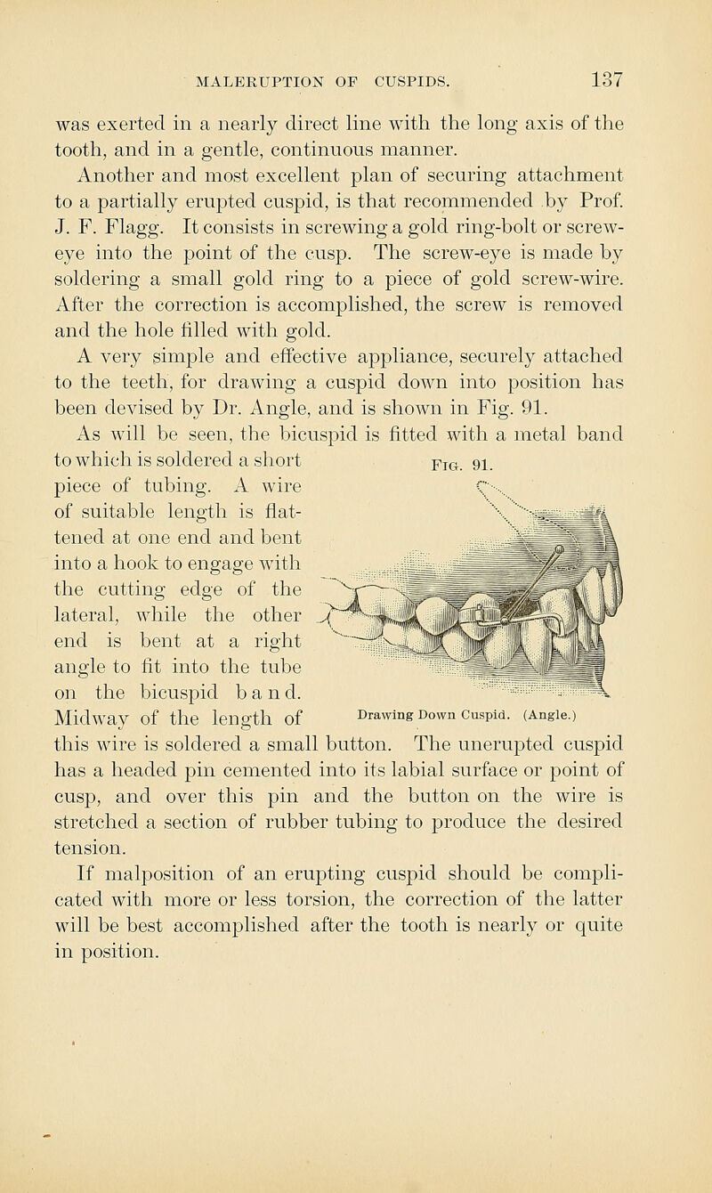 was exerted in a nearly direct line with the long axis of the tooth, and in a gentle, continuous manner. Another and most excellent j)laii of securing attachment to a partially erupted cuspid, is that recommended by Prof. J. F. Flagg. It consists in screwing a gold ring-bolt or screw- eye into the point of the cusp. The screw-eye is made by soldering a small gold ring to a piece of gold screw-wire. After the correction is accomplished, the screw is removed and the hole filled with gold. A very simple and effective appliance, securely attached to the teeth, for drawing a cuspid down into position has been devised by Dr. Angle, and is shown in Fig. 91. As will be seen, the bicuspid is fitted with a metal band to which is soldered a short piece of tubing. A wire of suitable length is flat- tened at one end and bent into a hook to engage with the cutting edge of the lateral, while the other end is bent at a right angle to fit into the tube on the bicuspid band. Midway of the length of Fig. 91. Drawing Down Cuspid. (Angle.) this wire is soldered a small button. The unerupted cuspid has a headed pin cemented into its labial surface or point of cusp, and over this pin and the button on the wire is stretched a section of rubber tubing to produce the desired tension. If malposition of an erupting cuspid should be compli- cated with more or less torsion, the correction of the latter will be best accomplished after the tooth is nearly or quite in position.