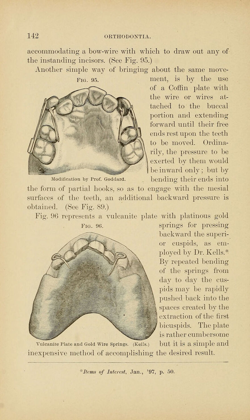 accommodating a bow-wire witli which to draw out any of the instanding incisors. (See Fig. 95.) Another simple way of bringing about tlie same move- FiG. 95. ment, is by tire use of a Coffin j)late with the wire or wires at- tached to the buccal portion and extending forward until their free ends rest upon the teeth to be moved. Ordina- rily, the pressure to be exerted by them would be inward only; but by Modiflcition bv Prof Goddard. bending their ends into the form of partial hooks, so as to engage with the mesial surfaces of the teeth, an additional backward pressure is obtained. (See Fig. 89.) Fig. 96 represents a vulcanite plate with platinous gold springs for pressing backward the superi- or cuspids, as em- ployed by Dr. Kells.^ By repeated bending of the springs from day to day the cus- ] )ids may be rapidly I aished back into the -paces created by the extraction of the first bicuspids. The plate is rather cumbersome Vulcanite Plate and Gold Wire Springs. (Kells.) but it is a simple aild inexpensive method of accomplishing the desired result. Fig. 96. C^ e^.. ^Itvms of Interest, Jan., '97, p. 50.