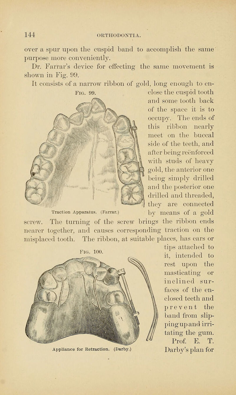 Fig. 99. over a spur upon the cuspid band to accomplish the same purpose more conveniently. Dr. Farrar's device for effecting the same movement is shown in Fig. 99. It consists of a narrow ribbon of gold, long enough to en- close the cuspid tooth and some tooth back of the space it is to occupy. The ends of this ribbon nearly meet on the buccal side of the teeth, and after being reenforced with studs of heavy gold, the anterior one being simply drilled and the posterior one drilled and threaded, they are connected Traction Apparatus. (Farrar.) j^y meaUS of a gold screw. The turning of the screw brings the ribbon ends nearer together, and causes corresponding traction on the misplaced tooth. The ribbon, at suitable places, has ears or tips attached to it, intended to rest upon the masticating or inclined sur- faces of the en- closed teeth and prevent the band from slip- ping up and irri- tating the gum. Prof E. T. Appliance for Retraction. (Darby.) Darby's plan for Fig. 100.