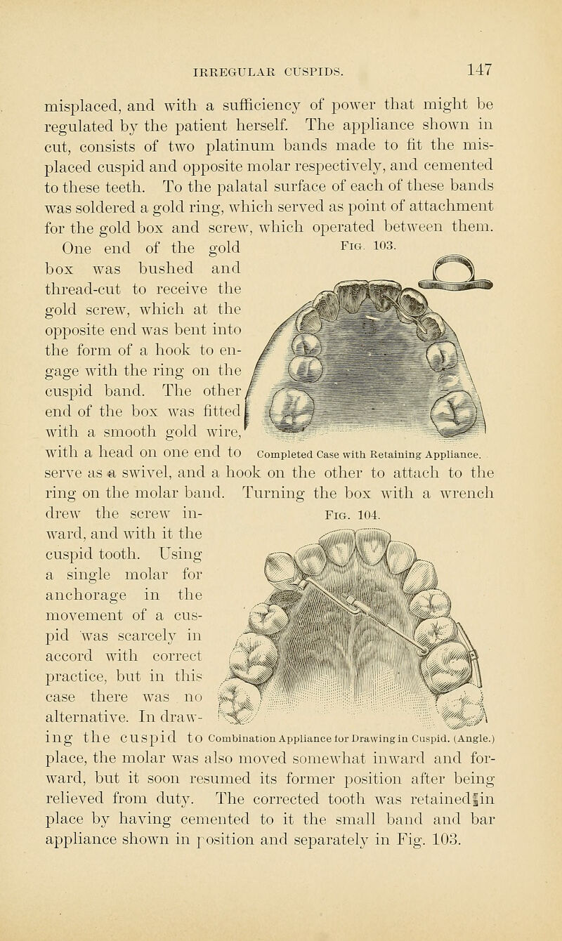 misplaced, and with a sufficiency of power that might be regulated by the patient herself. The appliance shown in cut, consists of two platinum bands made to fit the mis- placed cuspid and opposite molar respectively, and cemented to these teeth. To the palatal surface of each of these bands was soldered a gold ring, which served as point of attachment for the gold box and screw, which operated between them. One end of the gold Fig. 103. box was bushed and thread-cut to receive the gold screw, which at the opposite end was bent into the form of a hook to en- gage with the ring on the cuspid band. The other end of the box was fitted with a smooth gold wire, with a head on one end to completed case with Retaining Appliance. serve as a swivel, and a hook on the other to attach to the ring on the molar band. Turning the box with a wrench drew the screw in- Fig. 104. ward, and with it the cuspid tooth. Using a single molar for anchorage in the movement of a cus- pid was scarcely in accord with correct practice, but in this -^i^ case there was no kJ' ^, t alternative. In draw- % ing the cuspid to combination Appliance loi Drawing mCuspid. (Angle) place, the molar was also moved somewhat inward and for- ward, but it soon resumed its former position after being relieved from duty. The corrected tooth was retainedfin place by having cemented to it the small band and bar appliance shown in position and separately in Fig. 103. >0' It