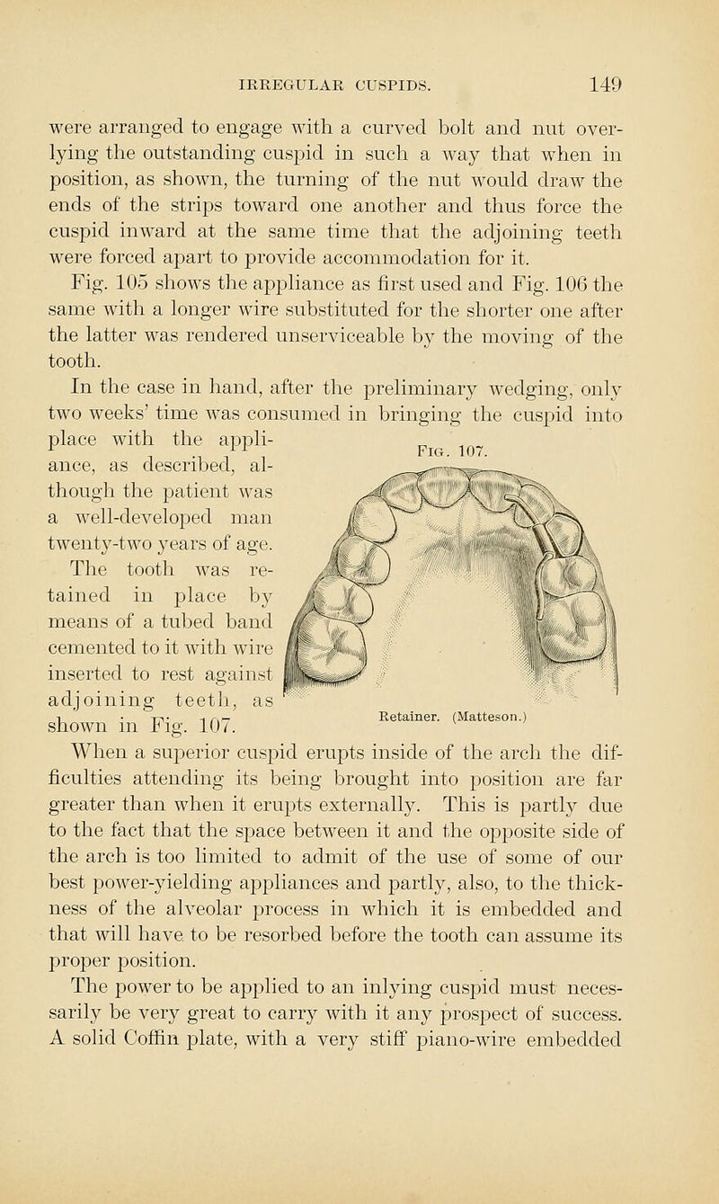 Fig. Ifn were arranged to engage with a curved bolt and nut over- lying the outstanding cusjjid in such a way that when in position, as shown, the turning of the nut would draw the ends of the strips toward one another and thus force the cuspid inward at the same time that the adjoining teeth were forced aj^art to provide accommodation for it. Fig. 105 shows the appliance as first used and Fig. 106 the same with a longer wire substituted for the shorter one after the latter was rendered unserviceable by the moving of the tooth. In the case in hand, after the preliminary wedging, only two weeks' time was consumed in bringing the cuspid into place with the appli- ance, as described, al- though the patient was a well-developed man twenty-two years of age. The tooth was re- tained in place by means of a tubed band cemented to it with wire inserted to rest against adjoining teeth, as shown in Fig. 107. When a superior cusjDid erupts inside of the arch the dif- ficulties attending its being brought into position are far greater than when it erupts externally. This is partly due to the fact that the sjiace between it and the opposite side of the arch is too limited to admit of the use of some of our best power-yielding ajjpliances and partly, also, to the thick- ness of the alveolar process in which it is embedded and that will have to be resorbed before the tooth can assume its proper position. The power to be apj)lied to an inlying cuspid must neces- sarily be very great to carry with it any prospect of success. A solid Coffin plate, with a very stiff piano-wire embedded Retainer. (Matteson.)