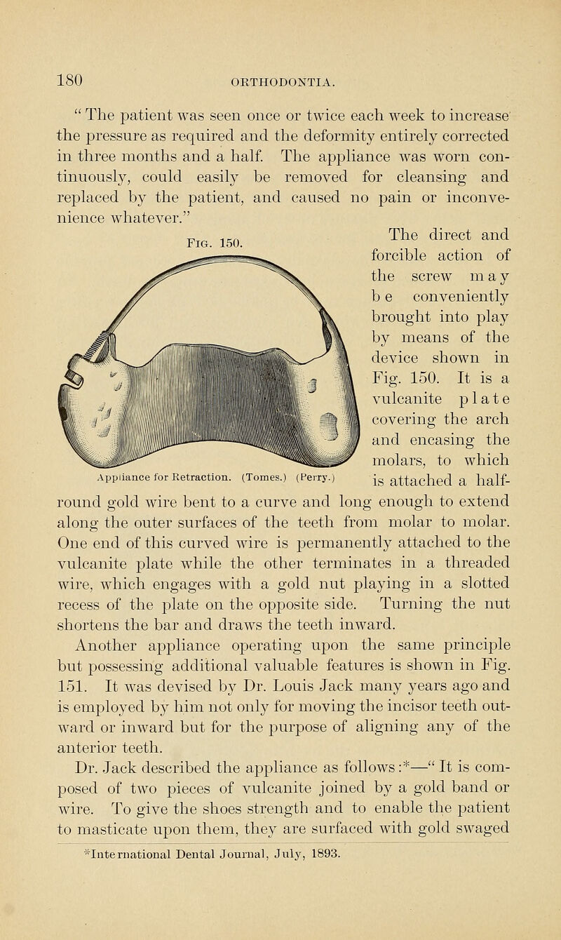 Fig. 150.  The patient was seen once or twice each week to increase' the pressure as required and the deformity entirely corrected in three months and a half. The appliance was worn con- tinuously, could easily be removed for cleansing and replaced by the patient, and caused no pain or inconve- nience whatever. The direct and forcible action of the screw m a y b e conveniently brought into play by means of the device shown in Fig. 150. It is a vulcanite plate covering the arch and encasing the molars, to which Appliance for Retraction. (Tomes.) (Perry.) is attached a lialf- round gold wire bent to a curve and long enough to extend along the outer surfaces of the teeth from molar to molar. One end of this curved wire is permanently attached to the vulcanite plate while the other terminates in a threaded wire, which engages with a gold nut playing in a slotted recess of the plate on the opposite side. Turning the nut shortens the bar and draws the teeth inward. Another appliance operating upon the same principle but possessing additional valuable features is shown in Fig. 151. It was devised by Dr. Louis Jack many years ago and is employed by him not only for moving the incisor teeth out- ward or inward but for the purpose of aligning any of the anterior teeth. Dr. Jack described the appliance as follows :*— It is com- posed of two pieces of vulcanite joined by a gold band or wire. To give the shoes strength and to enable the patient to masticate upon them, they are surfaced with gold swaged ■^International Dental Journal, Jnly, 1893.