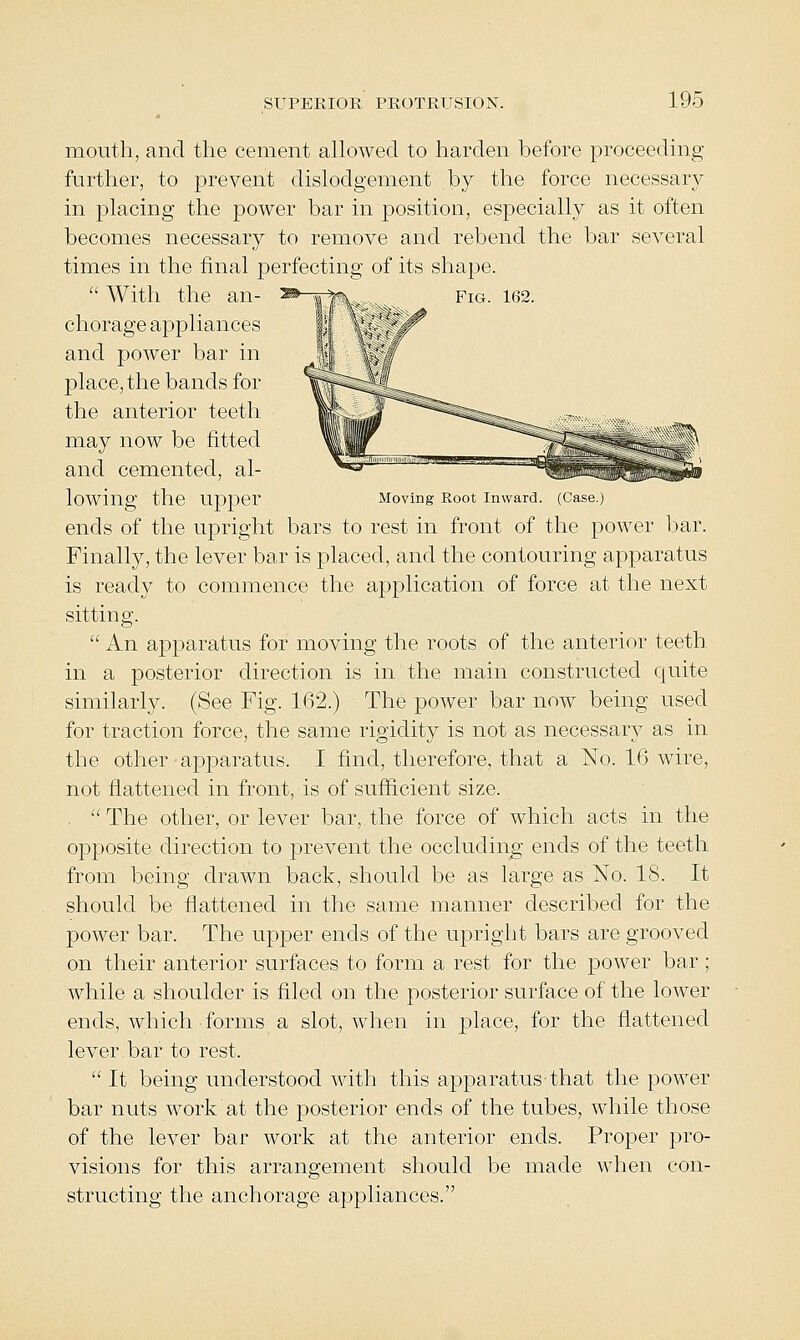 Fig. 162. mouth, and the cement allowed to harden before proceeding further, to prevent dislodgement by the force necessary in placing the power bar in position, especially as it often becomes necessary to remove and rebend the bar several times in the final perfecting of its shape. With the an- chorage appliances and power bar in place, the bands for the anterior teeth may now be fitted and cemented, al- lowing the upper Moving Root Inward. (Case.) ends of the upright bars to rest in front of the power bar. Finally, the lever bar is placed, and the contouring apparatus is ready to commence the application of force at the next sitting.  An apparatus for moving the roots of the anterior teeth in a posterior direction is in the main constructed quite similarly. (See Fig. 162.) The power bar now being used for traction force, the same rigidity is not as necessary as in the other apparatus. I find, therefore, that a No. 16 wire, not flattened in front, is of sufficient size. .  The other, or lever bar, the force of which acts in the opposite direction to prevent the occluding ends of the teeth from being drawn back, should be as large as No. 18. It should be flattened in the same manner described for the power bar. The upper ends of the upright bars are grooved on their anterior surfaces to form a rest for the power bar; while a shoulder is filed on the posterior surface of the lower ends, which forms a slot, when in j^lace, for the flattened lever.bar to rest.  It being understood with this apparatus that the power bar nuts work at the posterior ends of the tubes, while those of the lever bar work at the anterior ends. Proper pro- visions for this arrangement should be made when con- structing the anchorage appliances.