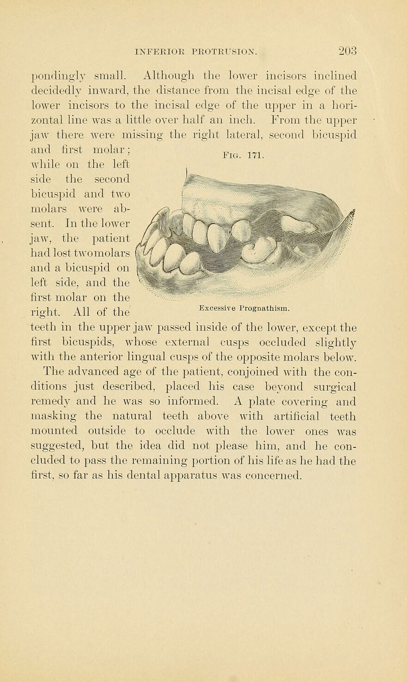 Fig. 171. pondingi}^ small. Although the lower incisors inclined decidedly inward, the distance from the incisal edge of the lower incisors to the incisal edge of the upper in a hori- zontal line was a little over half an inch. From the upper jaw there were missing the right lateral, second bicuspid and first molar; while on the left side the second bicuspid and two molars were ab- sent. In the lower jaw, the patient had lost twomolaif- and a bicuspid on left side, and the first molar on the right. All of the teeth in the upper jaw passed inside of the lower, except the first bicuspids, whose external cusps occluded slightly wuth the anterior lingual cusps of the opposite molars below. The advanced age of the patient, conjoined with the con- ditions just described, placed his case beyond surgical remedy and he was so informed. A plate covering and masking the natural teeth above with artificial teeth mounted outside to occlude with the lower ones was suggested, but the idea did not please him, and he con- cluded to pass the remaining portion of his life as he had the first, so far as his dental apparatus was concerned. Excessive Prognathism.