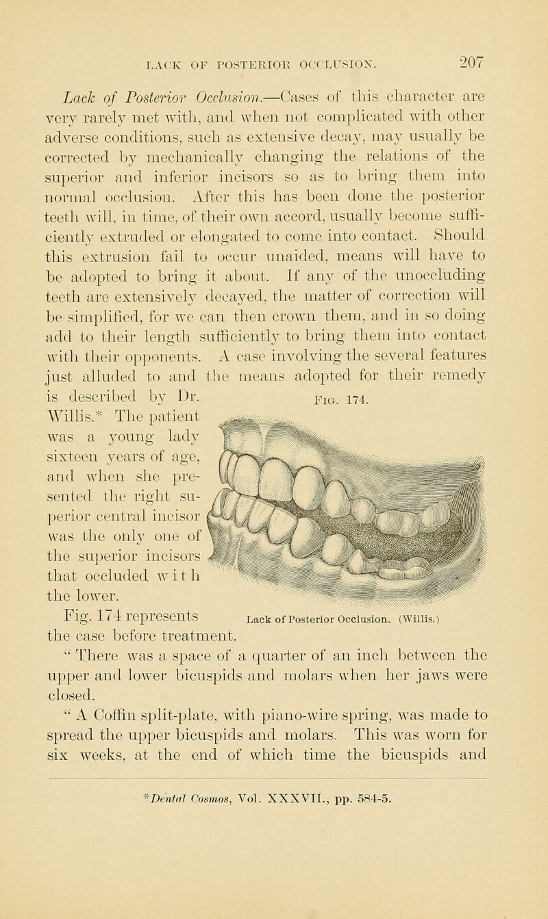 Lack of Posterior Occlusion.—Cases of this character are ver}^ rarely met with, and when not comi^Hcated with other adverse conditions, such as extensive decay, may usually be corrected by mechanically changing the relations of the superior and inferior incisors so as to bring them into normal occlusion. After this has been done the posterior teeth will, in time, of their own accord, usually become suffi- ciently extruded or elongated to come into contact. Should this extrusion fail to occur unaided, means will have to be adopted to bring it about. If any of the unoccluding teeth are extensively decayed, the matter of correction will be simplified, for we can then crown them, and in so doing add to their length sufficiently to bring them into contact with their opponents. A case involving the several features just alluded to and the means adopted for their remedy is described by Dr. Piq._ 174. Willis.* The patient was a young lady sixteen years of age, and when she pre- sented the right su- perior central incisor was the only one of the superior incisors that occluded w i t h the lower. Fig. 1 / 4 represents Lack of Posterior occlusion. (Willis.) the case before treatment.  There was a space of a quarter of an inch between the upper and lower bicuspids and molars when her jaws were closed.  A Coffin split-plate, with piano-wire spring, was made to spread the upper bicuspids and molars. This was worn for six weeks, at the end of which time the bicuspids and ^Dental Cosmos, VoL XXXVII., pp. 584-5.