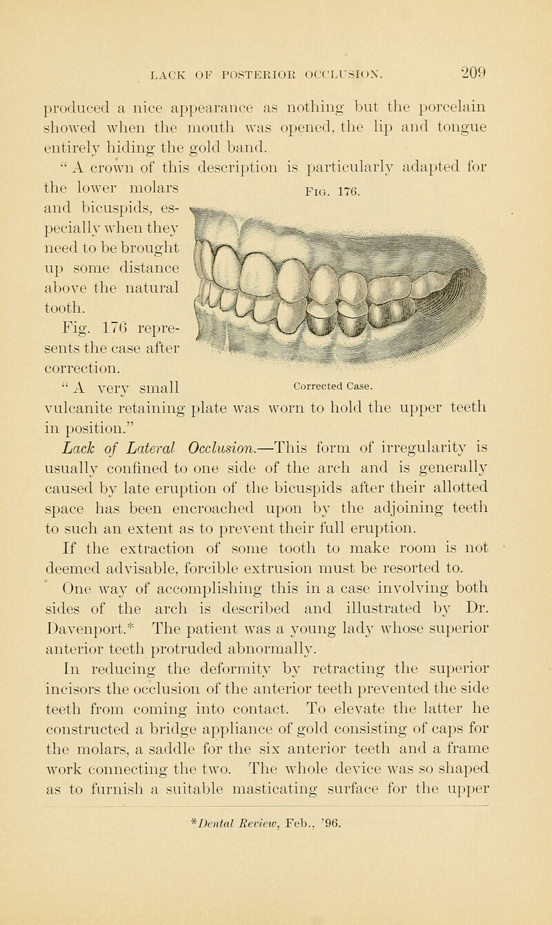 produced a nice appearance as nothing but the porcelain showed when the mouth was opened, tlie Up and tongue entirely hiding the gold band.  A crown of this description is particularly adapted for the lower molars yig. 176. and bicuspids, es- pecially when they need to be brought up some distance above the natural tooth. Fig. 176 repre- sents the case after correction.  A very small corrected Case. vulcanite retaining plate was worn to hold the upper teeth in position. Lack of Lateral Occlusion.—This form of irregularity is usually confined to one side of the arch and is generally caused by late eruption of the bicuspids after their allotted space has been encroached upon by the adjoining teeth to such an extent as to prevent their full eruption. If the extraction of some tooth to make room is not deemed advisable, forcible extrusion must be resorted to. One way of accomplishing this in a case involving both sides of the arch is described and illustrated by Dr. Davenport.* The patient was a young lady whose superior anterior teeth protruded abnormally. In reducing the deformity by retracting the superior incisors the occlu.sion of the anterior teeth prevented the side teeth from coming into contact. To elevate the latter he constructed a bridge appliance of gold consisting of caj)s for the molars, a saddle for the six anterior teeth and a frame work connecting the two. The whole device was so shaped as to furnish a suitable masticating surface for the upper