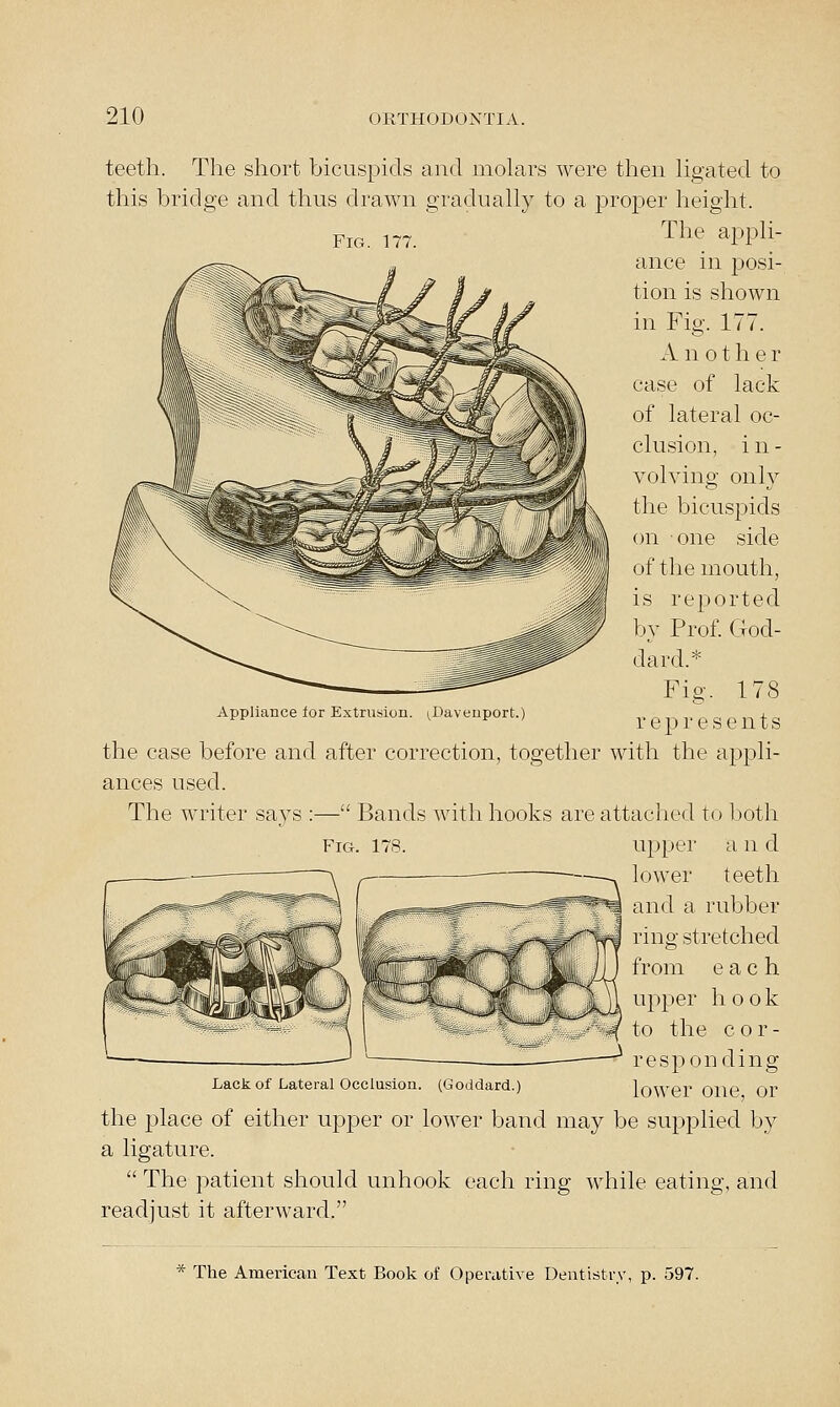 Fig. 177. teeth. The short bicuspids and molars were then hgated to this bridge and thus drawn gradually to a proper height. The appli- ance in posi- tion is shown in Fig. 177. A n 01 h e r case of lack of lateral oc- clusion, i n - volving only the bicusjDids on one side of the mouth, is reported by Prof. God- da rd.* Fig. 178 represents the case before and after correction, together with the appli- ances used. The writer says :— Bands with hooks are attached to lioth upper a n d lower teeth and a rubber ring stretched from each upper hook to the cor- responding Lack of Lateral Occlusion. (Goddard.) loWCT OllC Or the 23lace of either upper or lower band may be supplied by a ligature.  The patient should unhook each ring while eating, and readjust it afterward. Appliance lor Extnisiou. (.Davenport. Fig. 178.