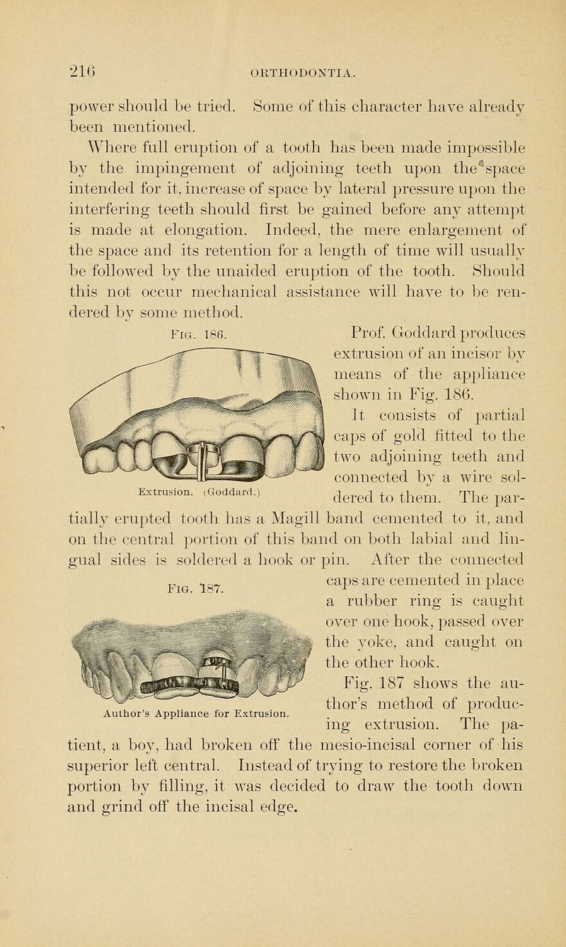 power should be tried. Some of this character have ah^eady been mentioned. Where full eruption of a tooth has been made impossible by the impingement of adjoining teeth upon the^space intended for it, increase of space by lateral pressure uj^on the interfering teeth should first be gained before any attempt is made at elongation. Indeed, the mere enlargement of the space and its retention for a length of time will usually be followed by the unaided eruption of the tooth. Should this not occur mechanical assistance will have to be ren- dered by some method. Fig. 186. Prof. Goddard produces extrusion of an incisor by means of the appliance shown in Fig. 186. It consists of i^artial caps of gold fitted to the two adjoining teeth and connected by a wire sol- dered to them. Tlie par- tially erupted tooth has a Magill band cemented to it, and on the central portion of this band on both labial and lin- gual sides is soldered a hook or pin. After the connected ^ caps are cemented in place a rubber ring is caught ^_ ^^^^tma^ Q^g^, Q^-^g hook, passed over the yoke, and caught on the other hook. Fig. 187 shows the au- thor's method of produc- ing extrusion. The pa- tient, a boy, had broken off the mesio-incisal corner of his superior left central. Instead of trying to restore the broken portion by filling, it was decided to draw the tooth down and grind off the incisal edge. Extrusion. (Goddard.) Author's Appliance for Extrusion