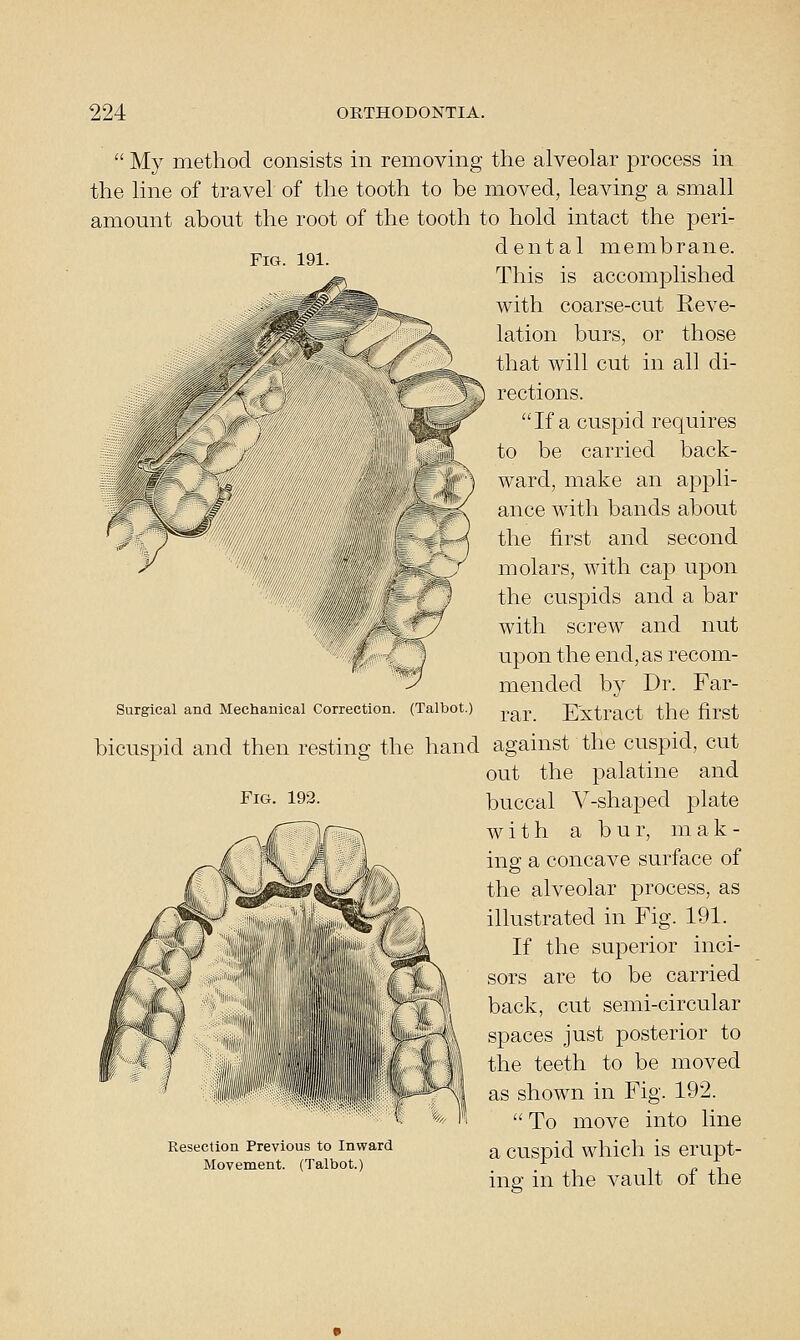 Fig. 191.  My method consists in removing the alveolar process in the line of travel of the tooth to be moved, leaving a small amount about the root of the tooth to hold intact the peri- dental membrane. This is accomplished with coarse-cut Reve- lation burs, or those that will cut in all di- rections. If a cuspid requires to be carried back- ward, make an appli- ance with bands about the first and second molars, with cap upon the cuspids and a bar with screw and nut , upon the end, as recom- ^y mended by Dr. Far- Surgical and Mechanical Correction. (Talbot.) j,^p Extract the first bicuspid and then resting the hand against the cuspid, cut out the palatine and buccal V-shaped plate with a bur, mak- ins a concave surface of the alveolar process, as illustrated in Fig. 191. If the superior inci- sors are to be carried back, cut semi-circular spaces just posterior to the teeth to be moved as shown in Fig. 192.  To move into line a cuspid which is erupt- ing in the vault of the Fig. 192. Resection Previous to Inward Movement. (Talbot.)