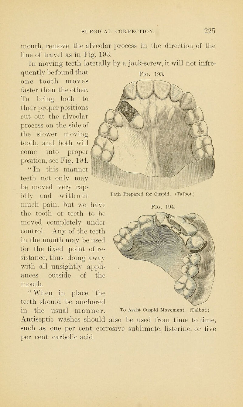 Fig. 193. mouth, remove the alveolar process in the direction of the line of travel as in Fig. 193. In moving teeth laterally by a jack-screw, it will not infre- quenth^ be found that one tooth moves faster than the other. To bring both to their proper positions cut out the alveolar process on the side of the slower moving tooth, and both will come into |)roj)er position, see Fig. 194.  In this manner teeth not only may be moved very rap- idly and without much pain, but we have the tooth or teeth to be moved completely under control. Any of the teeth in the mouth may be used for the fixed point of re- sistance, thus doing away with all unsightly appli- ances outside of the mouth.  When in place the teeth should be anchored in the usual manner. to Assist cuspid Movement. (Talbot.) Antiseptic washes should also be used from time to time, such as one per cent, corrosive sublimate, listerine, or five per cent, carbolic acid. Path Prepared for Cuspid. (Talbot.