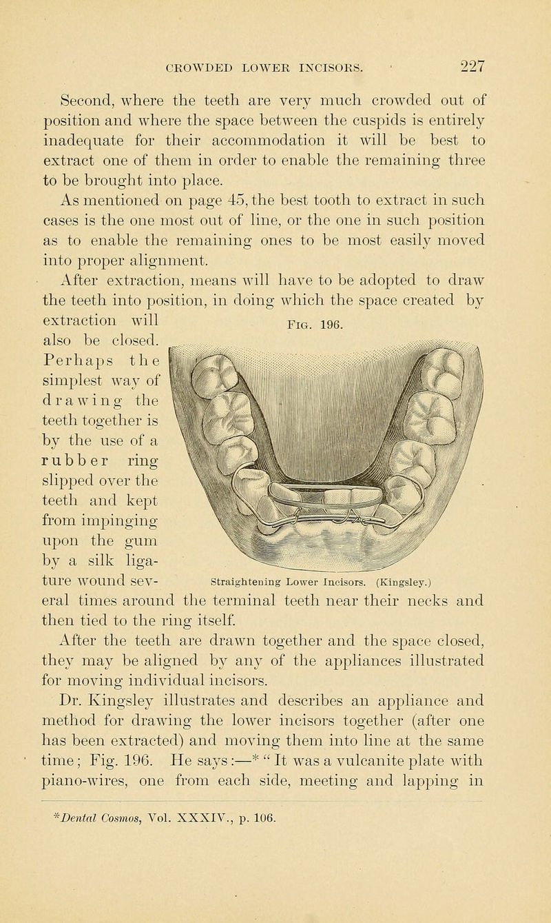 Second, where the teeth are very much crowded out of position and where the space between tlie cuspids is entirely inadec[uate for their accommodation it will be best to extract one of them in order to enable the remaining three to be brought into place. As mentioned on page 45, the best tooth to extract in such cases is the one most out of line, or the one in such position as to enable the remaining ones to be most easily moved into proper alignment. After extraction, means will have to be adopted to draw the teeth into position, in doing which the space created by extraction will Fig iqq also be closed. Perhaps the simplest way of ft (/ J^^ drawing the |% teeth together is by the use of a rubber ring slipped over the teeth and kept from impinging upon the gum by a silk liga- ture wound SeV- straightening Lower Incisors. (Kingsley.) eral times around the terminal teeth near their necks and then tied to the ring itself. After the teeth are drawn together and the space closed, they may be aligned by any of the apj^liances illustrated for moving individual incisors. Dr. Kingsley illustrates and describes an appliance and method for drawing the lower incisors together (after one has been extracted) and moving them into line at the same time; Fig. 196. He says:—*  It was a vulcanite plate Avith piano-wires, one from each side, meeting and lapping in