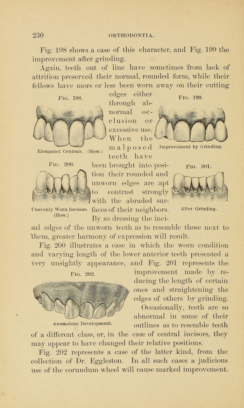 Fig. 198. Fig. 199. Elongated Centrals. (How.) Fig. 200. Improvement by Grinding. Fig. 201. Fig. 198 shows a case of this character, and Fig. 199 the improvement after grinding. Again, teeth out of hne have sometimes from lack of attrition preserved their normal, rounded form, while their fellows have more or less been worn away on their cutting edges either through ab- normal oc- clusion or excessive use. When the m a 1 p o s e d teeth have been brought into posi- tion their rounded and unworn edges are apt I to contrast strongly with the abraded sur- Unevenly Worn Incisors. facCS of their neighbors. °' By so dressing the inci- sal edges of the unworn teeth as to resemble those next to them, greater harmony of expression will result. Fig. 200 illustrates a case in which the worn condition and varying length of the lower anterior teeth presented a very unsightly appearance, and Fig. 201 represents the improvement made by re- ducing the length of certain ones and straightening the edges of others by grinding. Occasionally, teeth are so abnormal in some of their Anomalous Development. QUtKneS aS tO rCSCmblc tcoth of a different class, or, in the case of central incisors, they may appear to have changed their relative positions: Fig. 202 represents a case of the latter kind, from the collection of Dr. Eggleston. In all such cases a judicious use of the corundum wheel will cause marked improvement. After Grinding. Fig. 202.