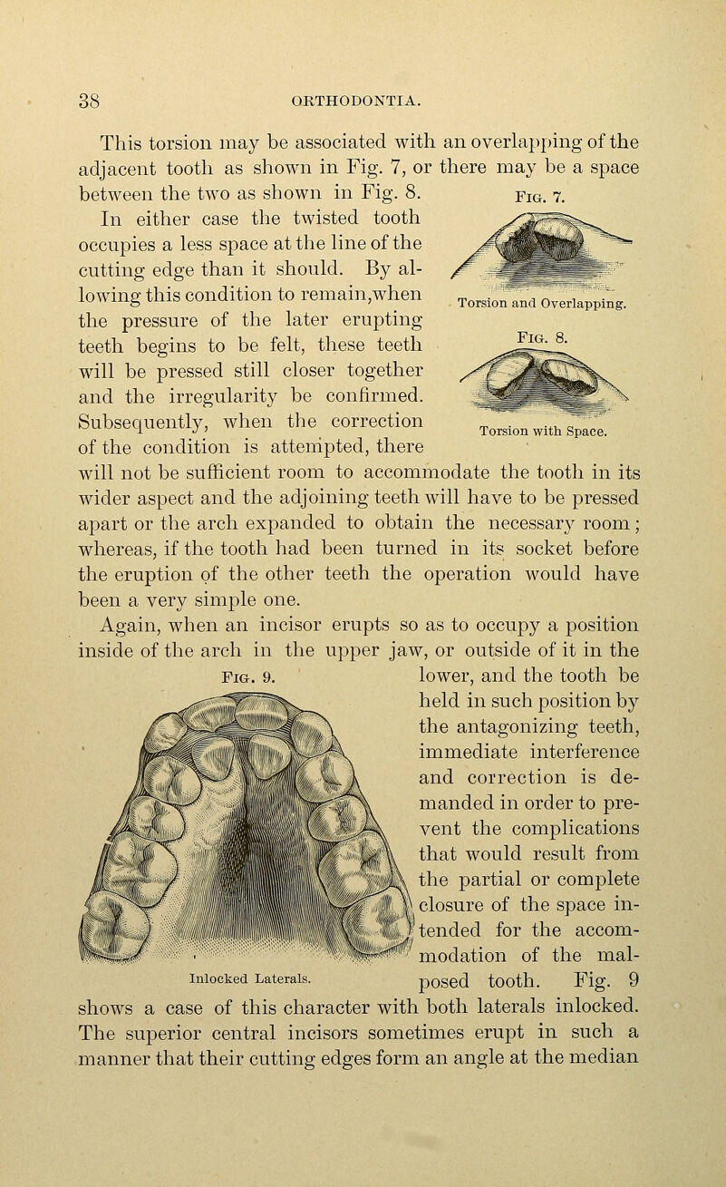 Torsion and Overlapping. Fig. 8. Torsion with Space. This torsion may be associated with an overlapping of the adjacent tooth as shown in Fig. 7, or there may be a space between the two as shown in Fig. 8. fig. 7. In either case the twisted tooth occupies a less space at the line of the cutting edge than it should. By al- lowing this condition to remain,when the pressure of the later erupting teeth begins to be felt, these teeth will be pressed still closer together and the irregularity be confirmed. Subsequently, when tlae correction of the condition is attempted, there will not be sujSicient room to accommodate the tooth in its wider aspect and the adjoining teeth will have to be pressed apart or the arch expanded to obtain the necessary room; whereas, if the tooth had been turned in its socket before the eruption of the other teeth the operation would have been a very simple one. Again, when an incisor erupts so as to occupy a position inside of the arch in the upper jaw, or outside of it in the Fig. 9. lower, and the tooth be held in such position by the antagonizing teeth, immediate interference and correction is de- manded in order to pre- vent the complications that would result from the partial or complete closure of the space in- tended for the accom- modation of the mal- Inlocked Laterals. pOSed tOOth. Fig. 9 shows a case of this character with both laterals inlocked. The superior central incisors sometimes erupt in such a manner that their cutting edges form an angle at the median