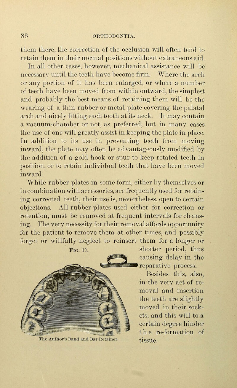 them there, the correction of the occlusion will often tend to retain them in their normal positions without extraneous aid. In all other cases, however, mechanical assistance will be necessary until the teeth have become firm. Where the arch or any portion of it has been enlarged, or where a number of teeth have been moved from within outward, the simplest and probably the best means of retaining them will be the wearing of a thin rubber or metal plate covering the palatal arch and nicely fitting each tooth at its neck. It may contain a vacuum-chamber or not, as preferred, but in many cases the use of one will greatly assist in keeping the plate in place. In addition to its use in preventing teeth from moving inward, the plate may often be advantageously modified by the addition of a gold hook or spur to keep rotated teeth in position, or to retain individual teeth that have been moved inward. While rubber plates in some form, either by themselves or in combination with accessories, are frequently used for retain- ing corrected teeth, their use is, nevertheless, open to certain objections. All rubber plates used either for correction or retention, must be removed at frequent intervals for cleans- ing. The very necessity for their removal affords opportunity for the patient to remove them at other times, and possibly forget or willfully neglect to reinsert them for a longer or shorter period, thus causing delay in the reparative process. Besides this, also, in the very act of re- moval and insertion the teeth are slightly moved in their sock- ets, and this will to a certain degree hinder the re-formation of The Author's Band and Bar Retainer. tisSUe Fig. 17.