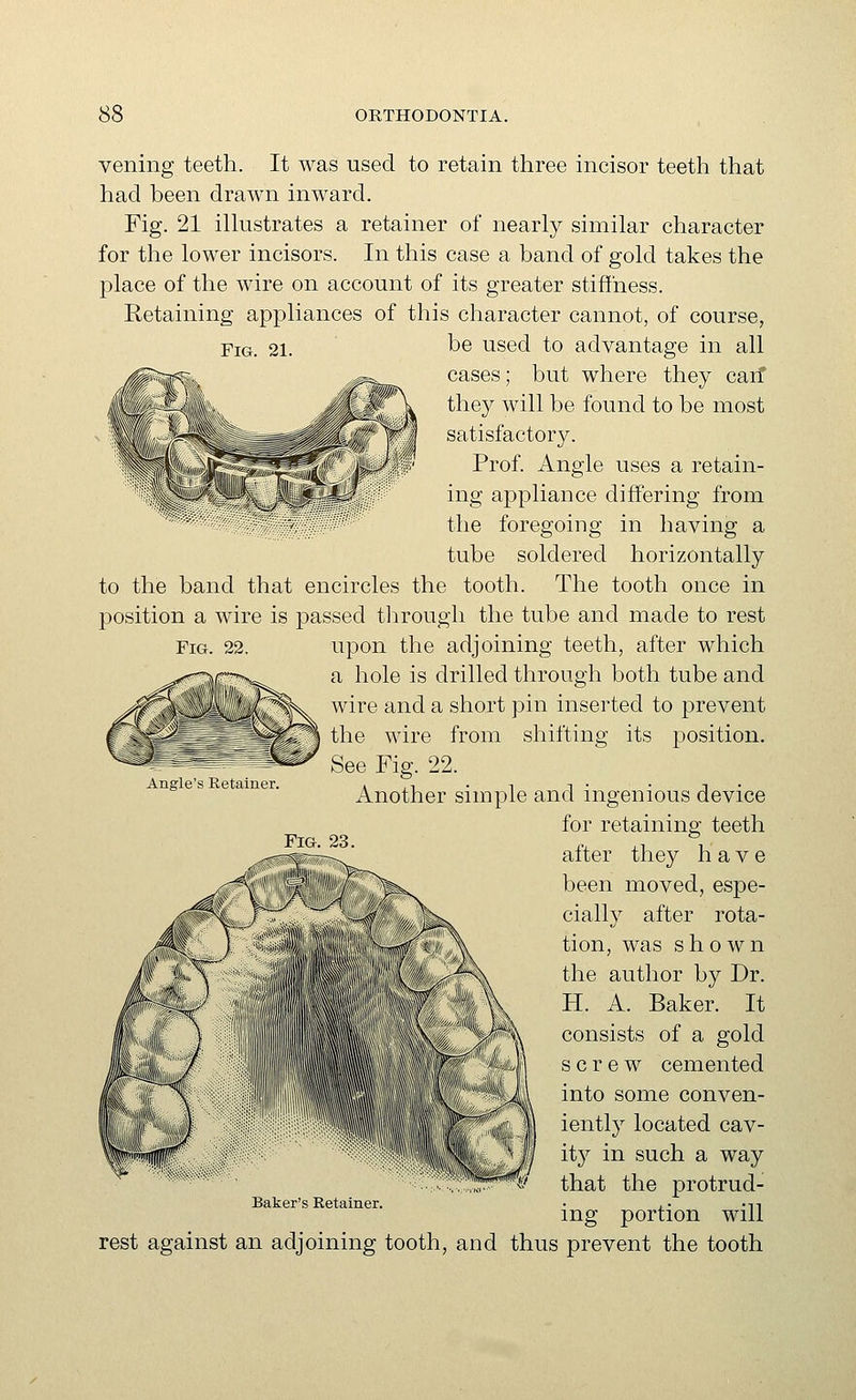 Fig. 22. vening teeth. It was used to retain three incisor teeth that had been drawn inward. Fig. 21 ilhistrates a retainer of nearly similar character for the lower incisors. In this case a band of gold takes the place of the wire on account of its greater stiffness. Retaining appliances of this character cannot, of course, Fig. 21. t)e used to advantage in all /^ ~ .«^=fe_. cases; but where they carf they will be found to be most satisfactory. Mir T^^^it ^lIL/r' Prof. Angle uses a retain- ing appliance differing from the foregoing in having a tube soldered horizontally to the band that encircles the tooth. The tooth once in position a wire is passed tlirough the tube and made to rest upon the adjoining teeth, after which a hole is drilled through both tube and wire and a short pin inserted to prevent the wire from shifting its position. See Fig. 22. Another simple and ingenious device for retaining teeth alter they have been moved, espe- cially after rota- tion, was shown the author by Dr. H. A. Baker. It consists of a gold screw cemented into some conven- ientl}^ located cav- ity in such a way that the protrud- ing portion will rest against an adjoining tooth, and thus prevent the tooth Angle's Ketainer. Baker s Retainer