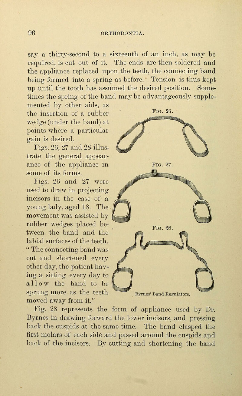Fig. 26. say a thirty-second to a sixteenth of an inch, as may be required, is cut out of it. The ends are then soldered and the appliance replaced upon the teeth, the connecting band being formed into a spring as before. Tension is thus kept up until the tooth has assumed the desired position. Some- times the spring of the band may be advantageously supple- mented by other aids, as the insertion of a rubber wedge (under the band) at points where a particular gain is desired. Figs. 26, 27 and 28 illus- trate the general appear- ance of the appliance in some of its forms. Figs. 26 and 27 were used to draw in projecting incisors in the case of a young lady, aged 18. The movement was assisted by rubber wedges placed be- tween the band and the labial surfaces of the teeth. The connecting band was cut and shortened every other day, the patient hav- ing a sitting every day to allow the band to be sprung more as the teeth moved away from it. Fig. 28 represents the form of appliance used by Dr. Byrnes in drawing forward the lower incisors, and pressing back the cuspids at the same time. The band clasped the first molars of each side and passed around the cuspids and back of the incisors. By cutting and shortening the band Byrnes' Band Regulators.